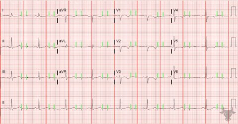 Pacemaker Malfunction Ecg Stampede Pacemaker Malfunction Ecg Stampede