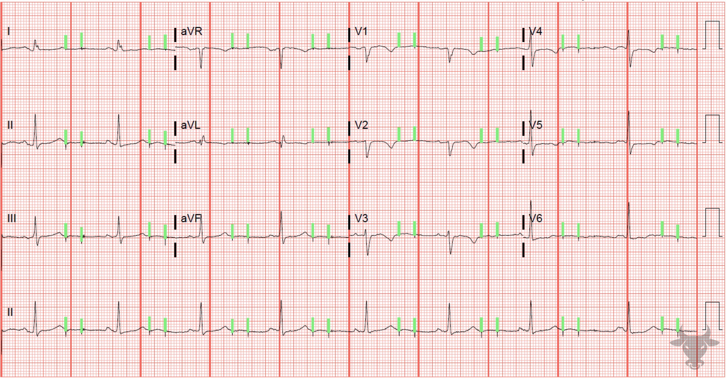ECG Showing Pacemaker Malfunction