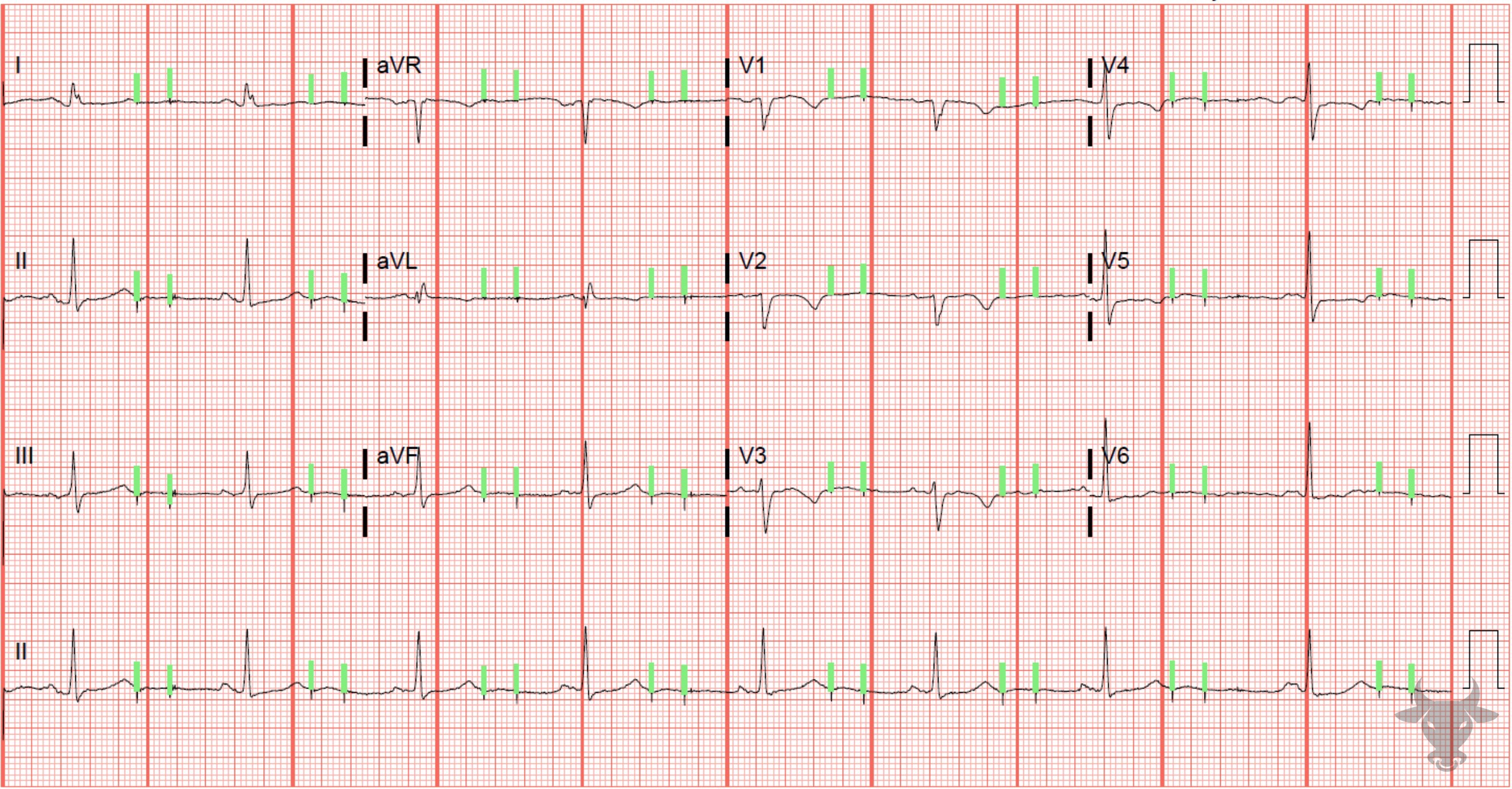 ECG Showing Pacemaker Malfunction