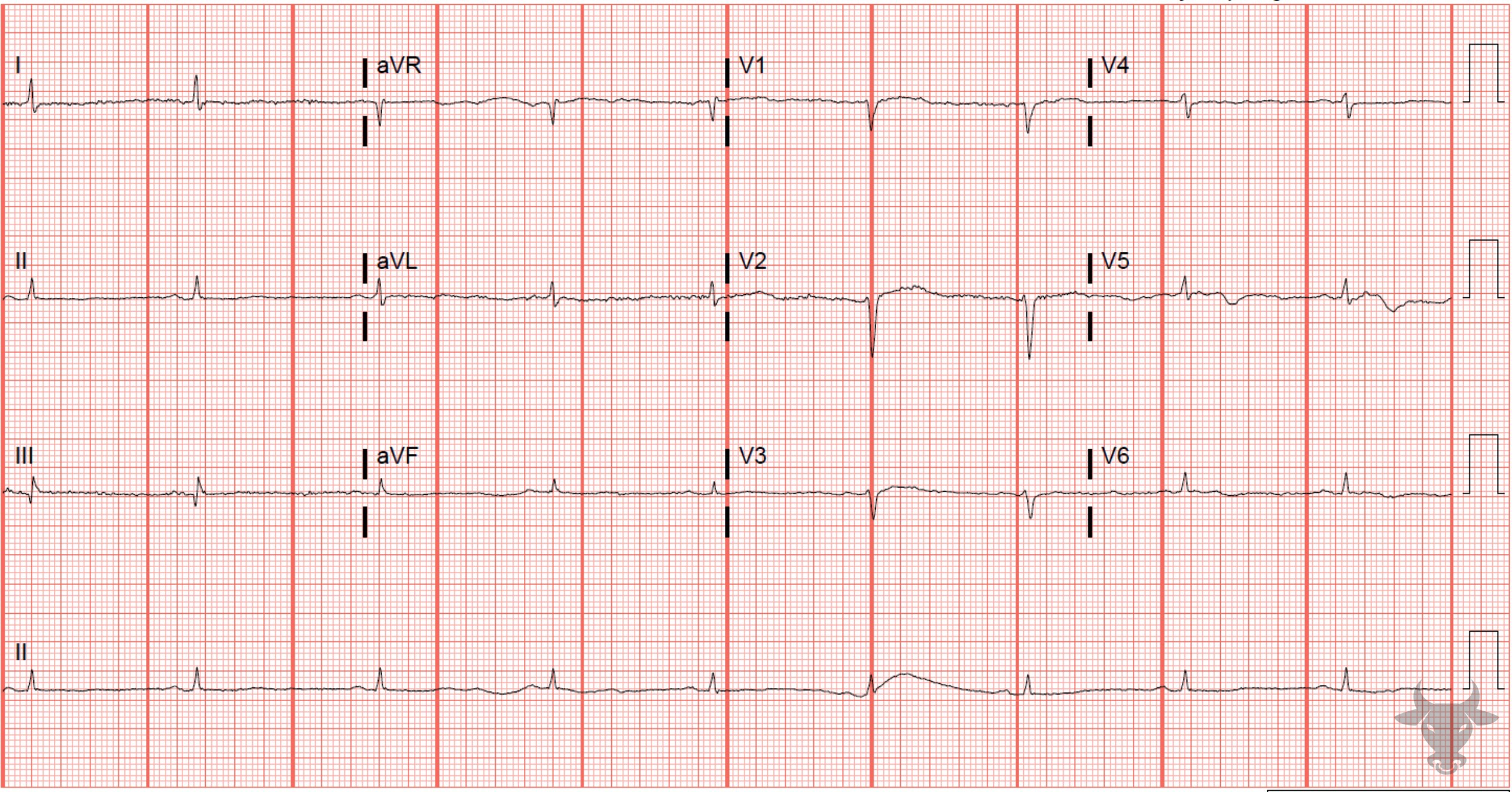 ECG Showing Low Voltage