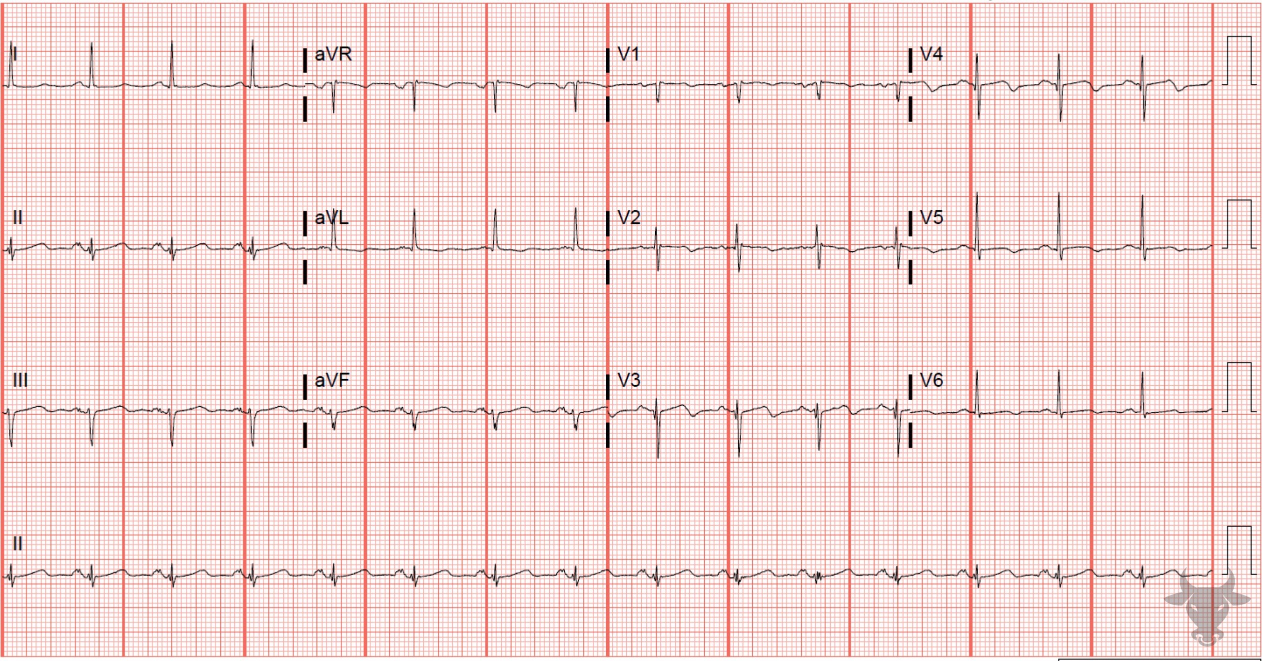 ECG Showing T-wave Inversions