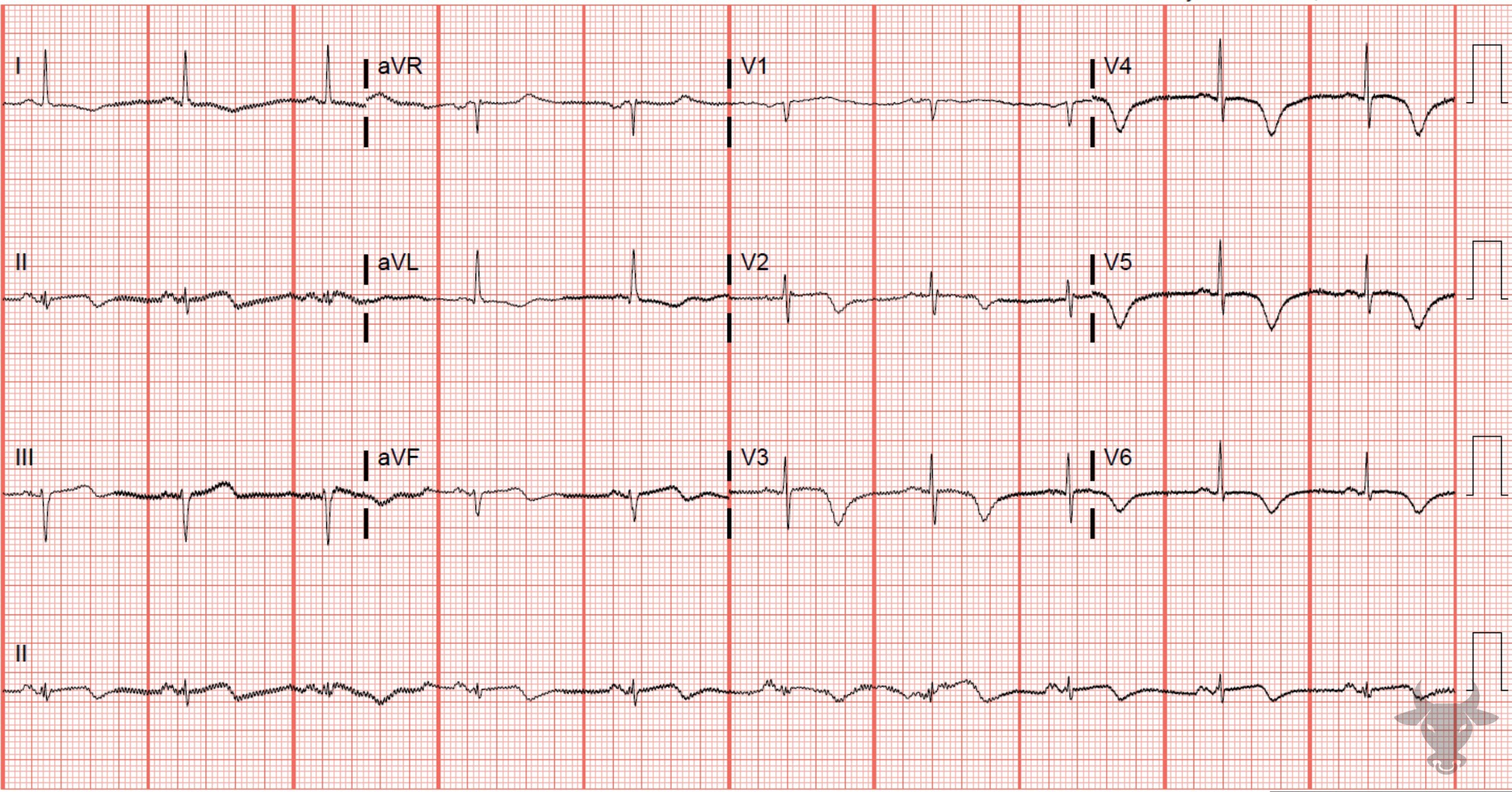 ECG Showing Wellens Syndrome