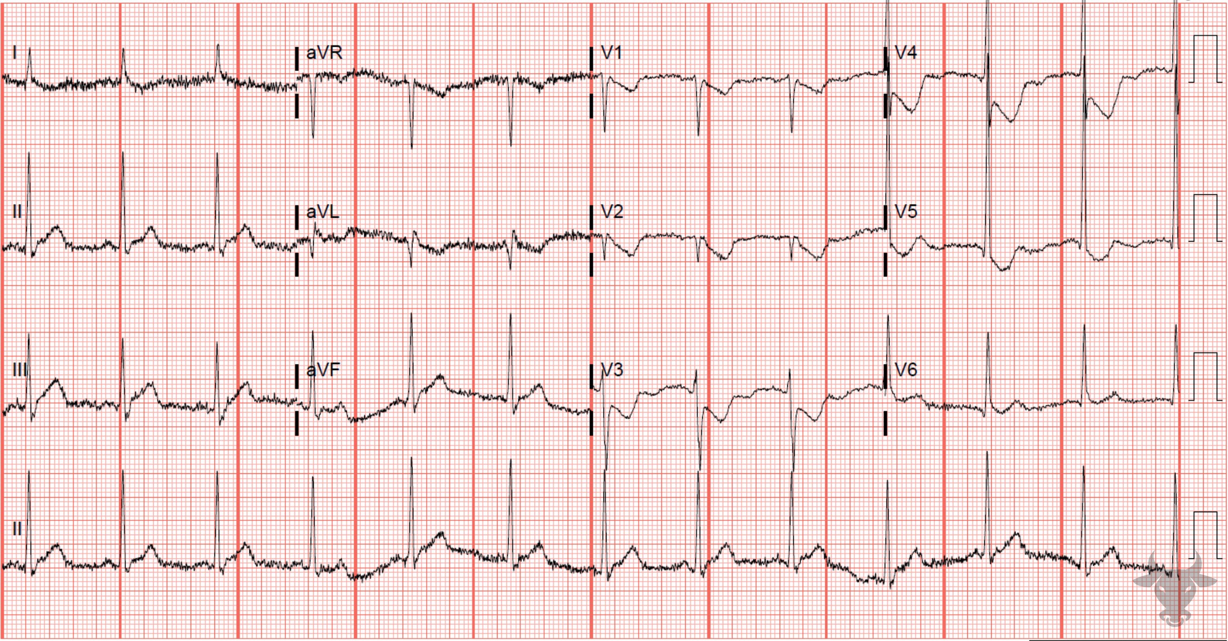 ECG Showing Posterior Myocardial Infarction