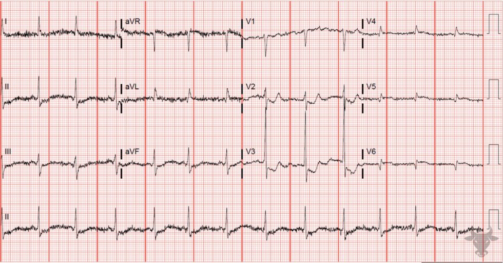ST-elevation Myocardial Infarction | ECG Stampede