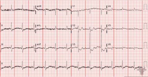 Posterior Myocardial Infarction | ECG Stampede