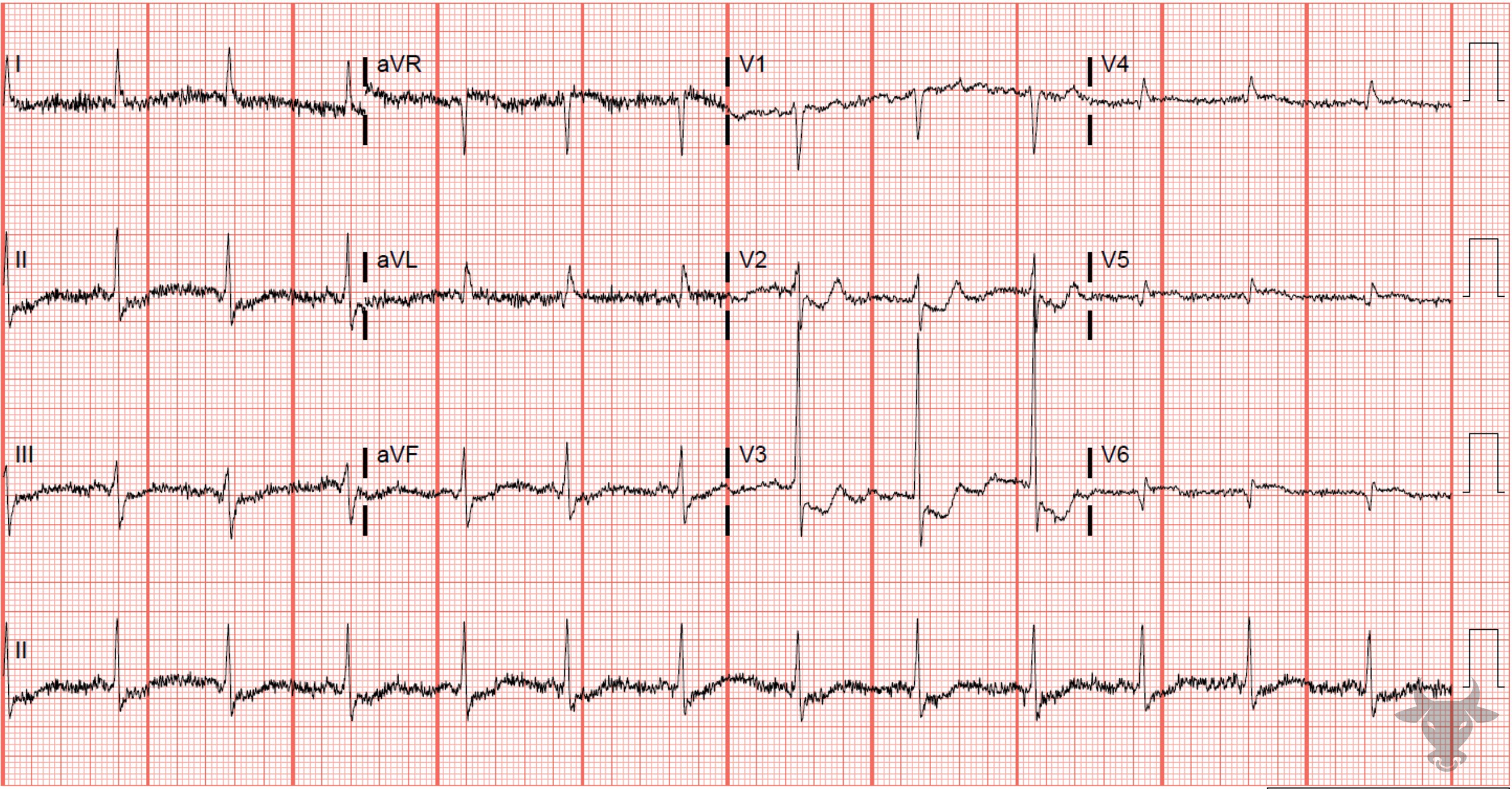 ECG Showing Posterior Myocardial Infarction