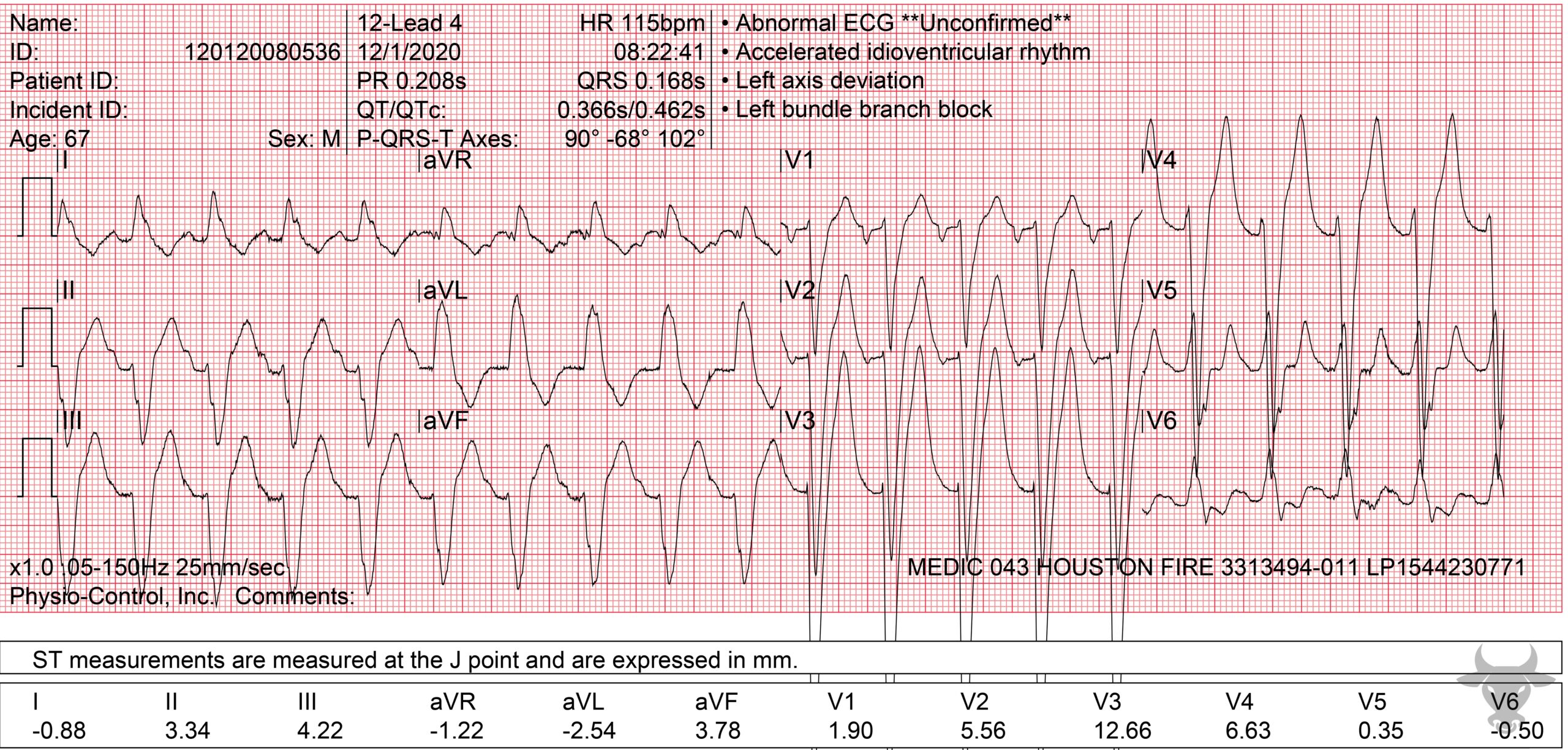 ECG Showing Left Bundle Branch Block