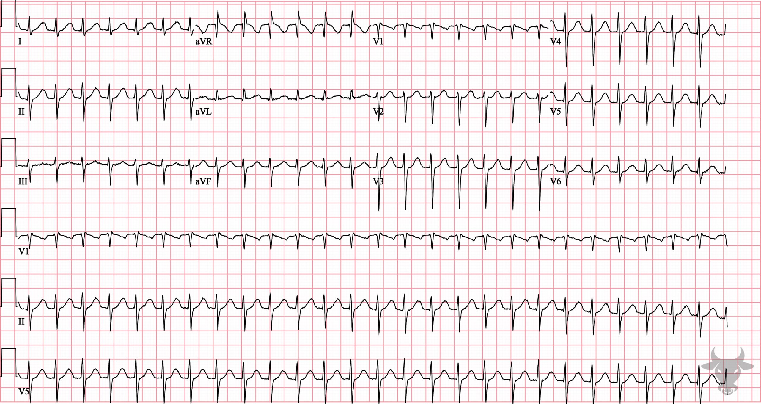 ECG Showing Supraventricular Tachycardia