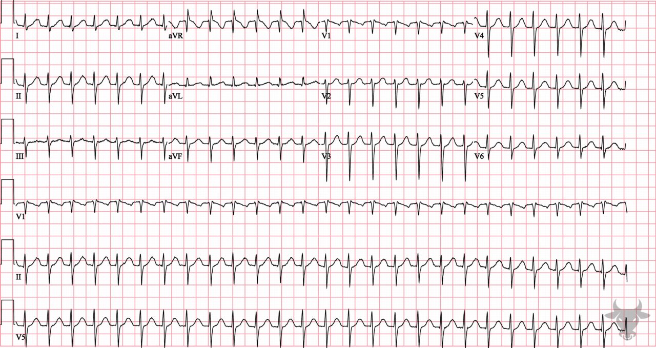 Atrioventricular Nodal Reentrant Tachycardia | ECG Stampede