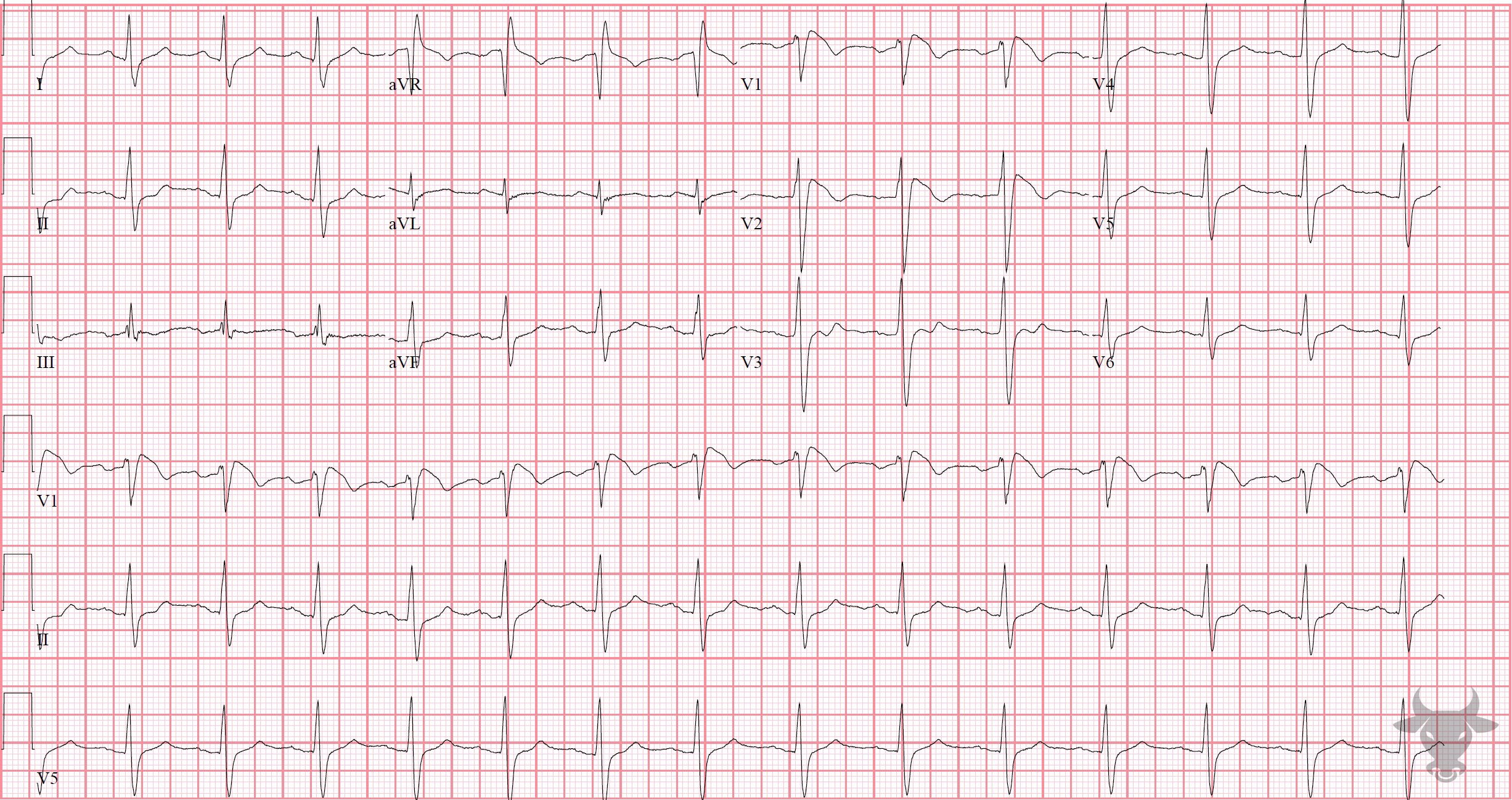 ECG Showing Brugada Syndrome