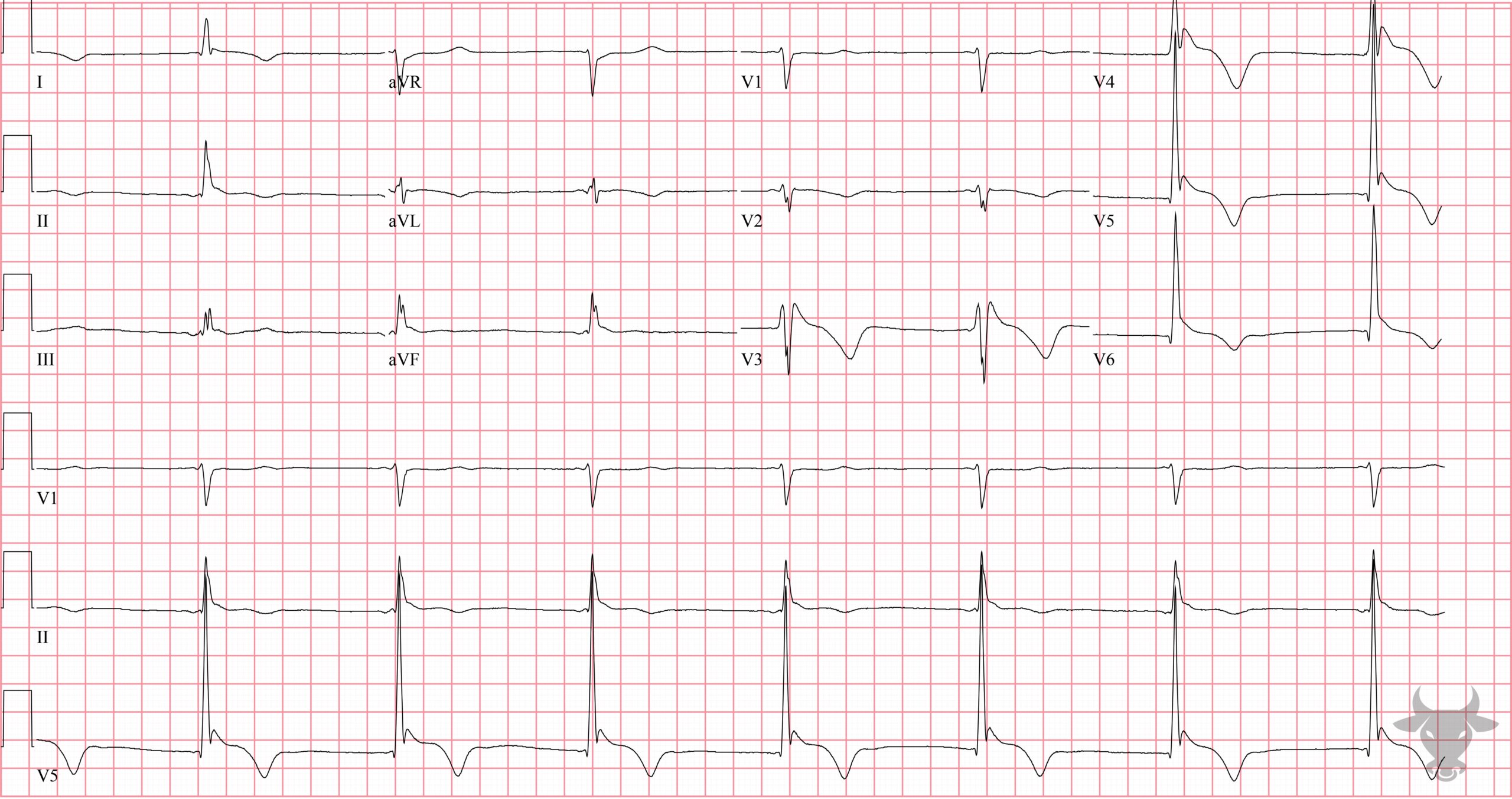 ECG Showing Hypothermia