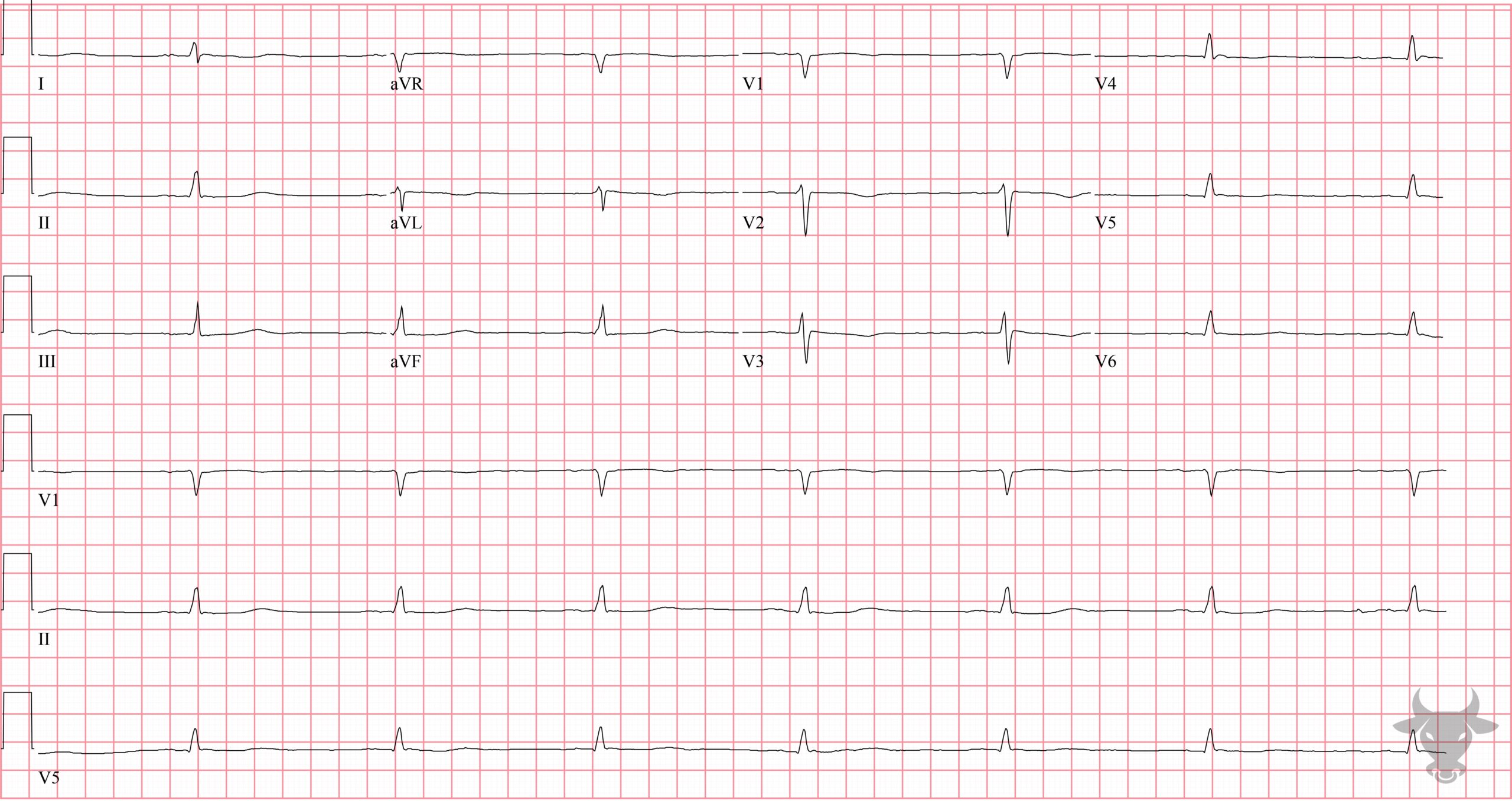 ECG Showing Low Voltage