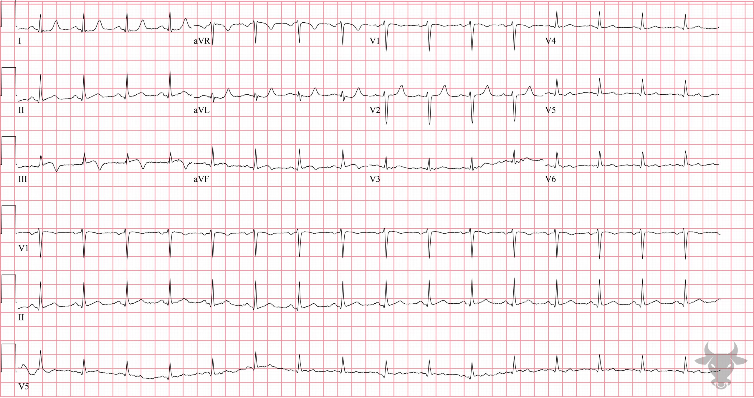 ECG Showing ST-elevation Myocardial Infarction