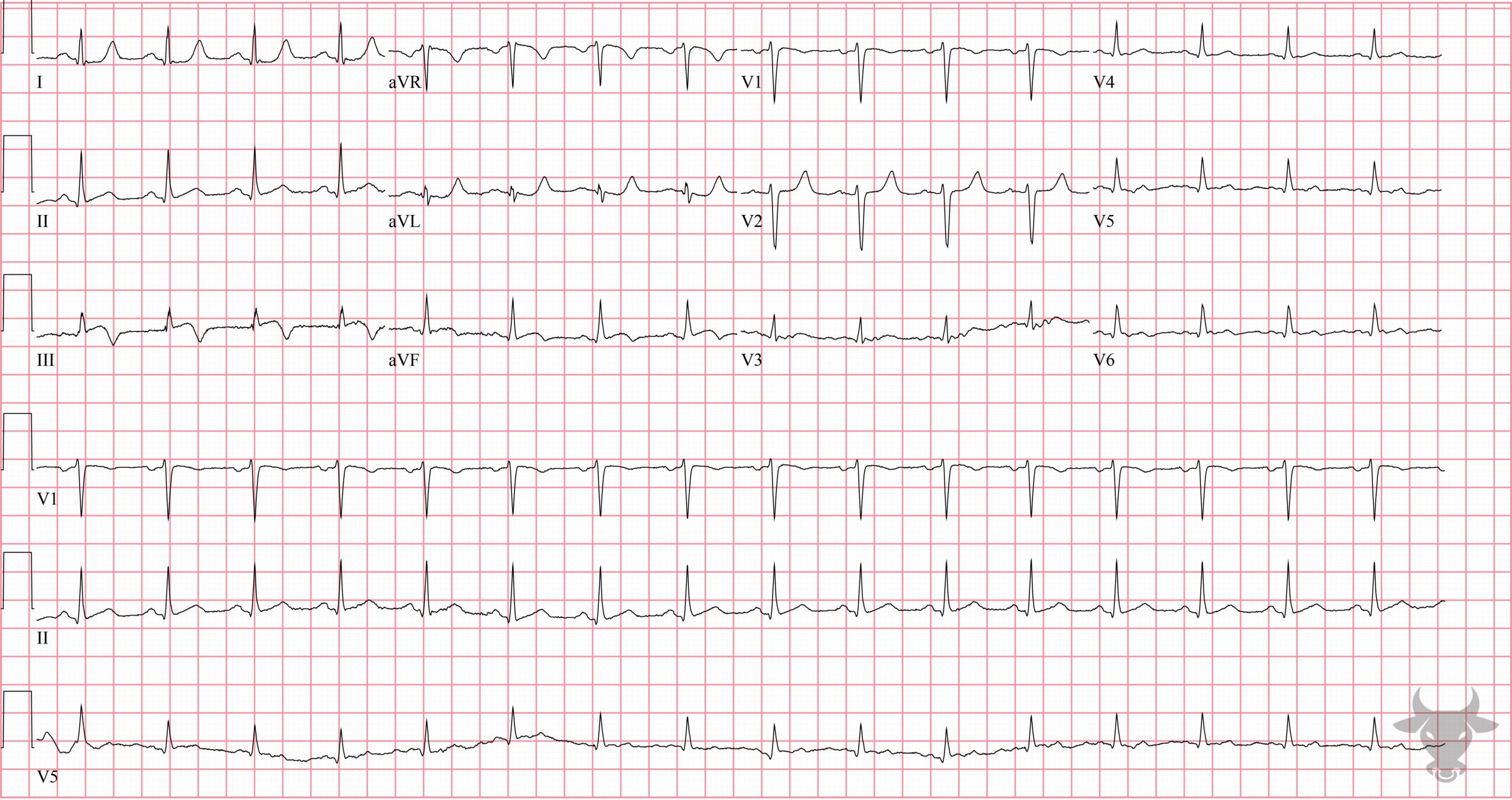 ECG Showing ST-elevation Myocardial Infarction