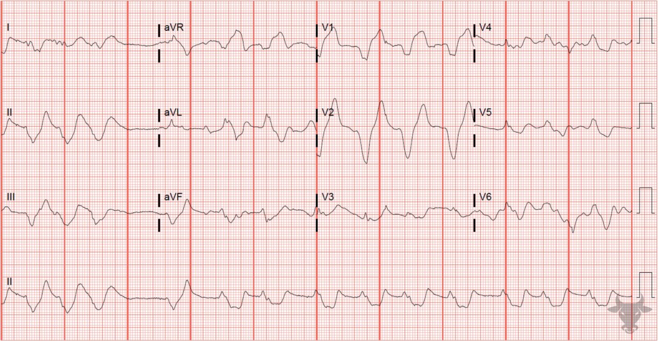 Hyperkalemia ecg stampede