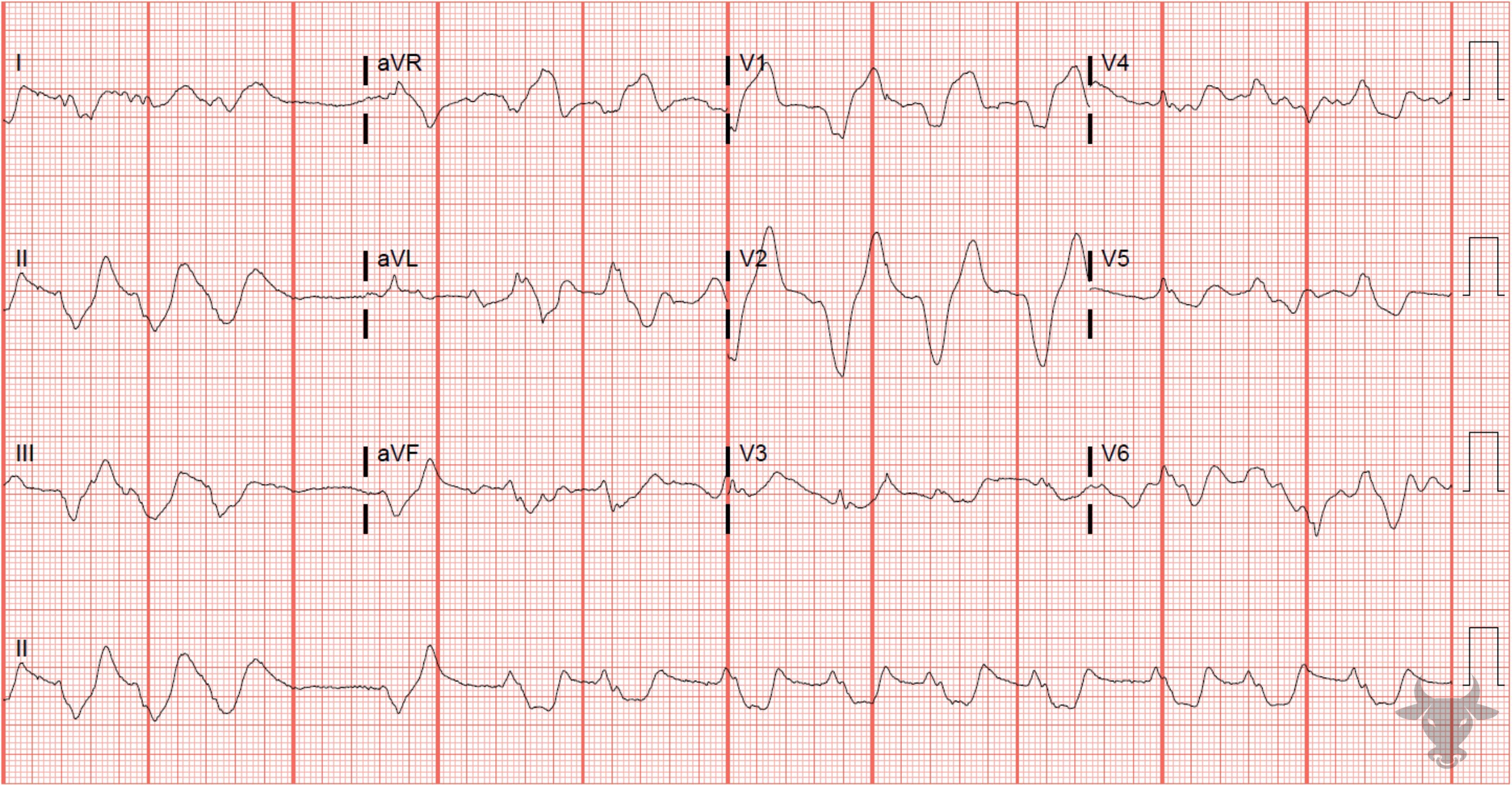 ECG Showing Hyperkalemia