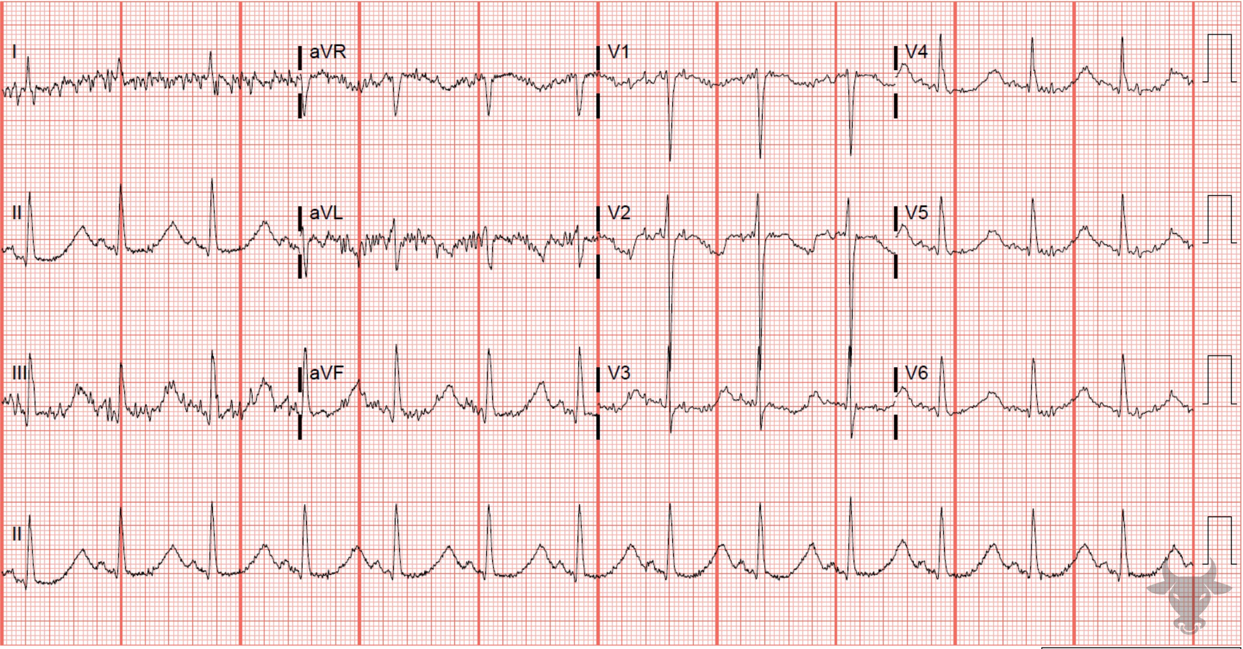 ECG Showing Hypokalemia