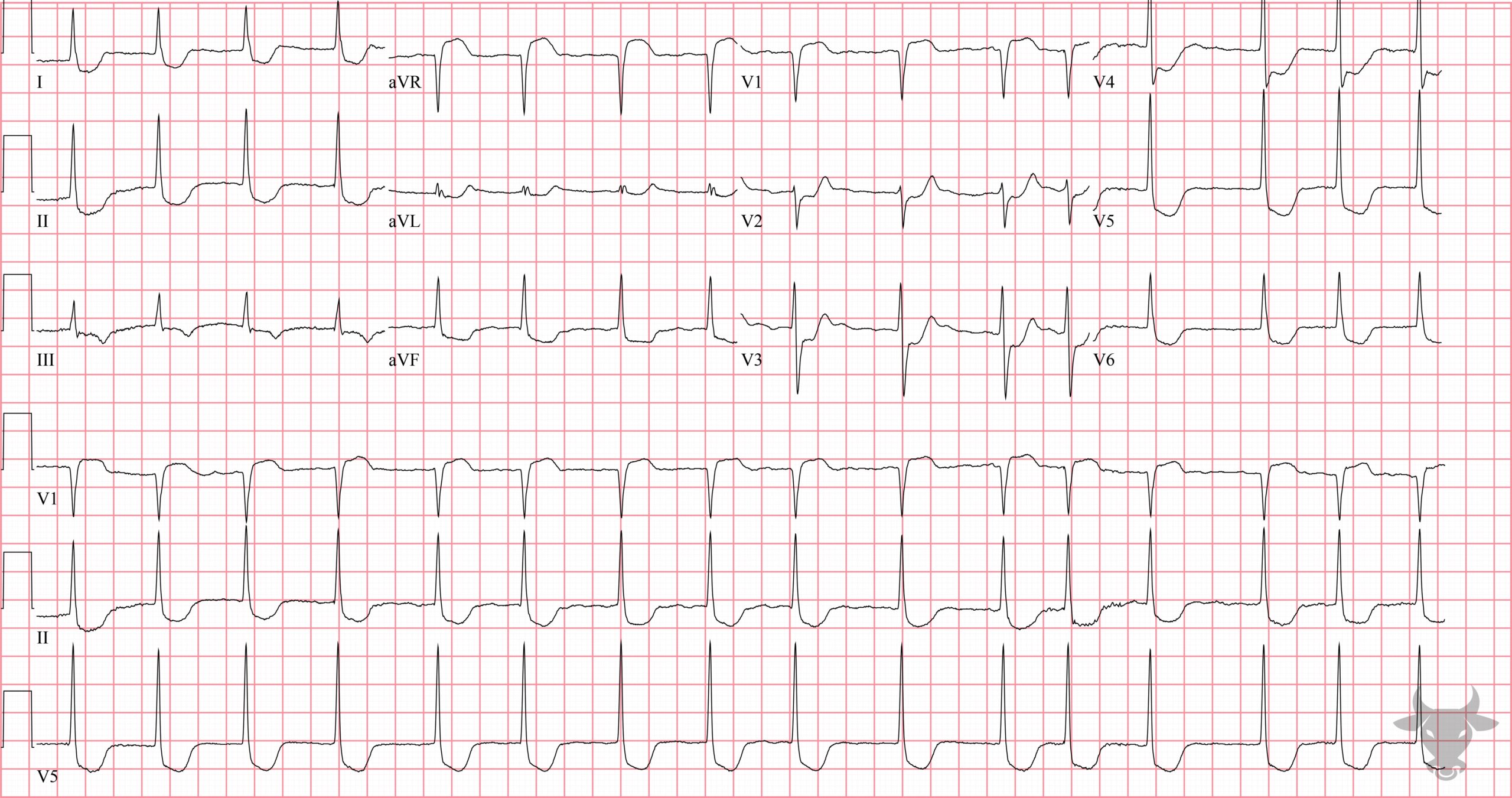 ECG Showing Atrial Flutter