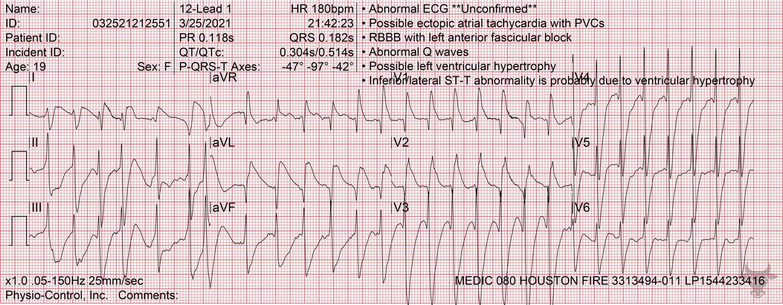 ECG Showing Ventricular Tachycardia