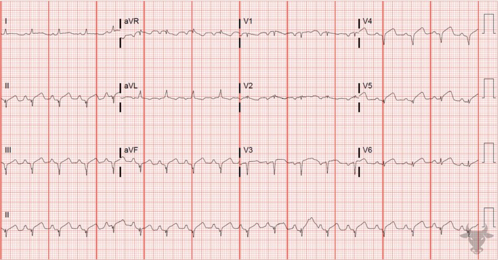 ST-elevation Myocardial Infarction | ECG Stampede