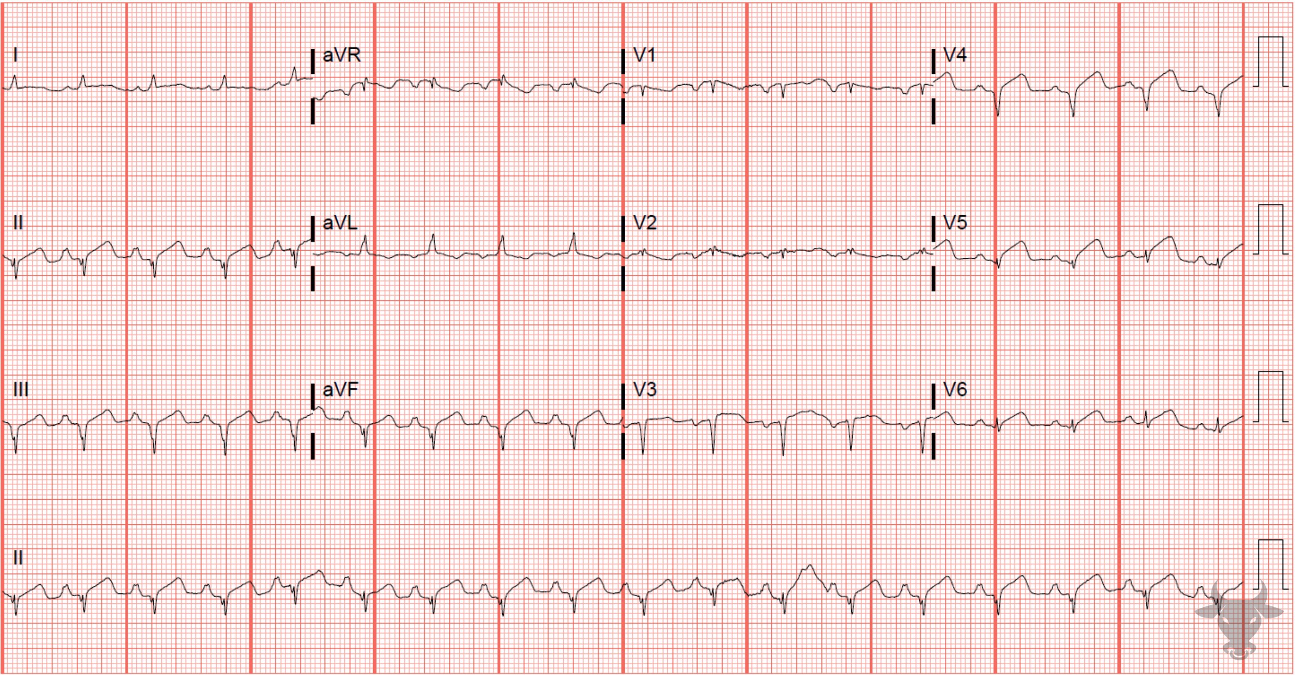 ECG Showing Hyperacute T Waves