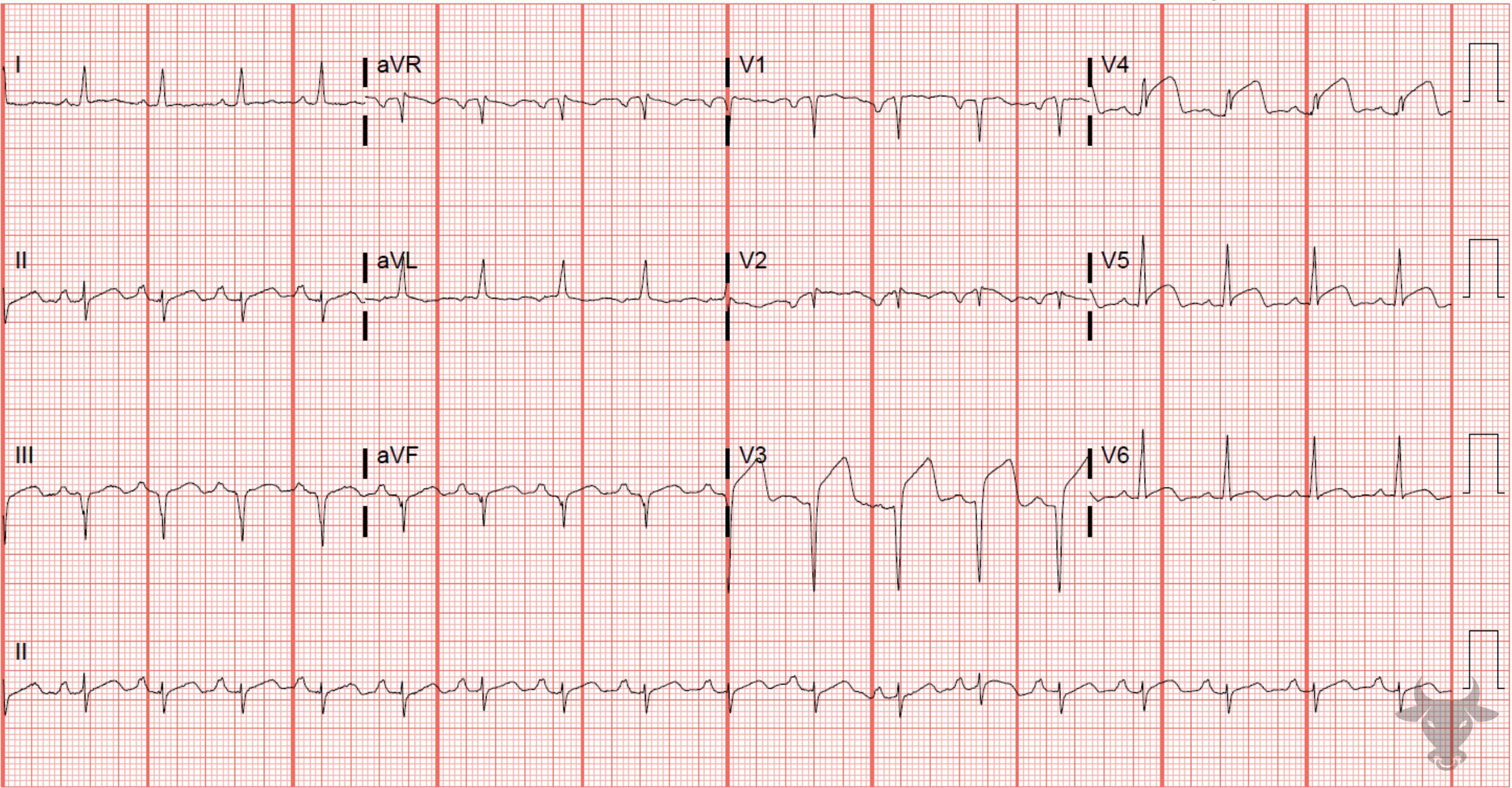 ECG Showing ST-elevation Myocardial Infarction