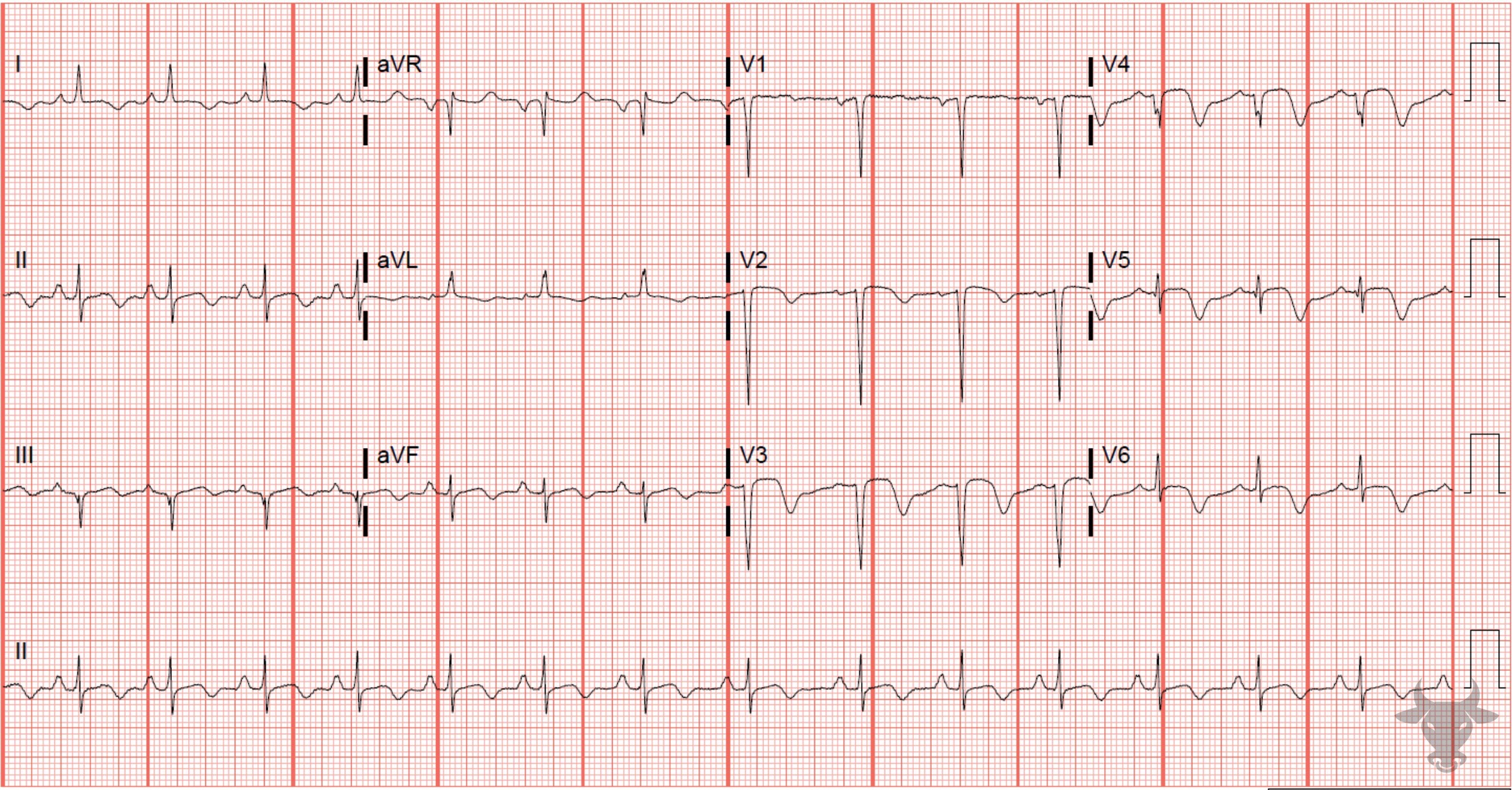 ECG Showing Wellens Syndrome