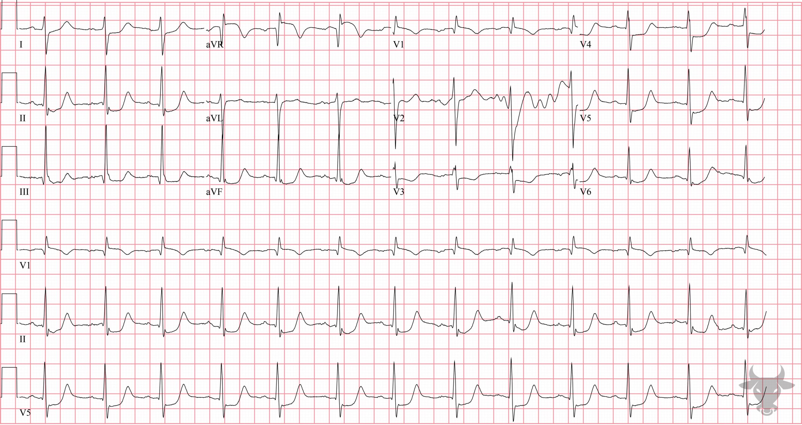 ECG Showing Global Subendocardial Ischemia