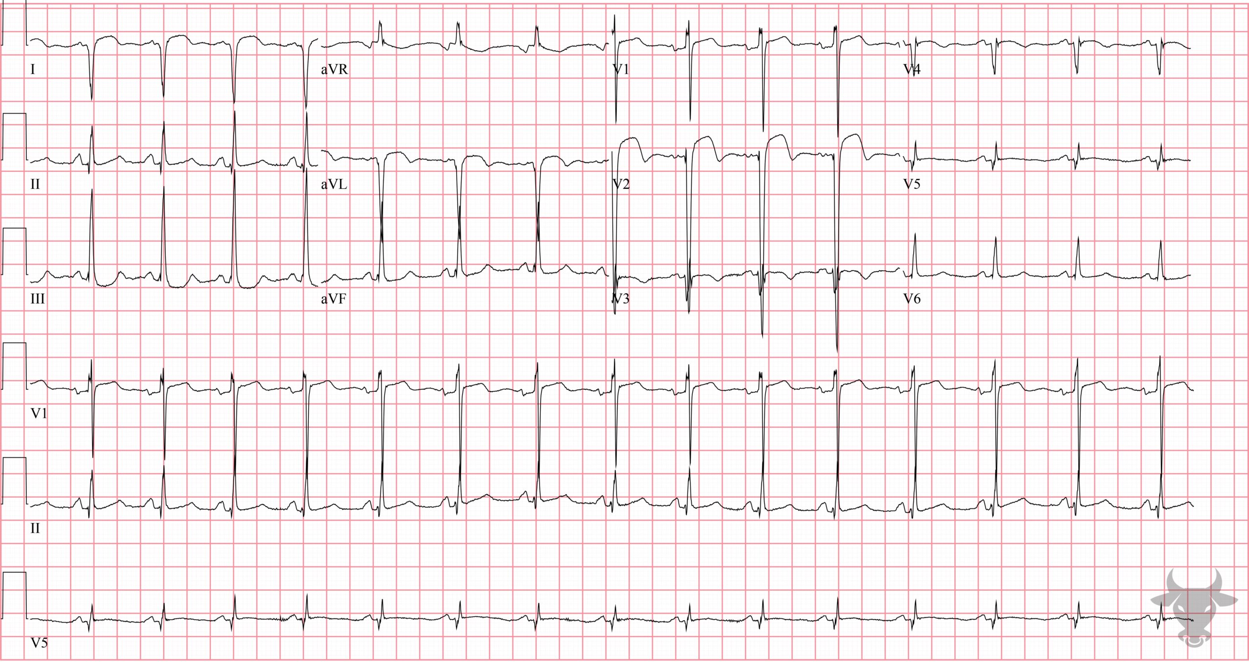 ECG Showing Left Ventricular Aneurysm