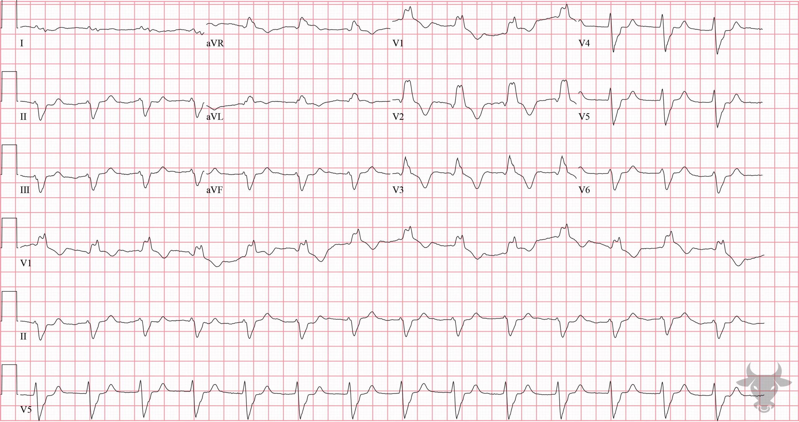 ECG Showing Right Bundle Branch Block with Left Anterior Fascicular Block