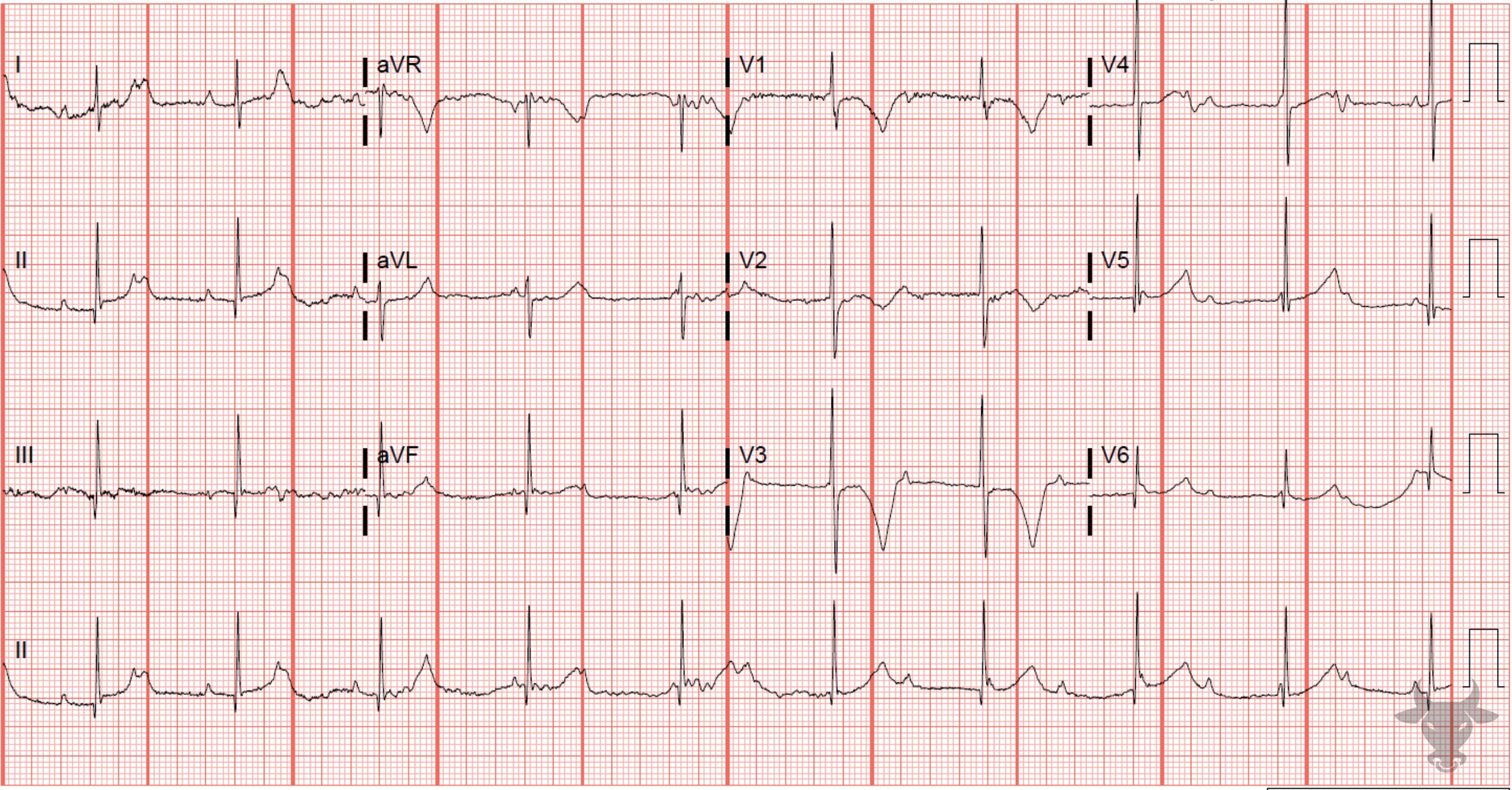 ECG Showing Third Degree Atrioventricular Block