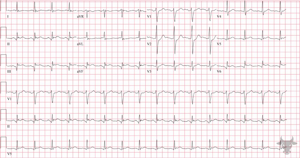 ST-elevation Myocardial Infarction | ECG Stampede
