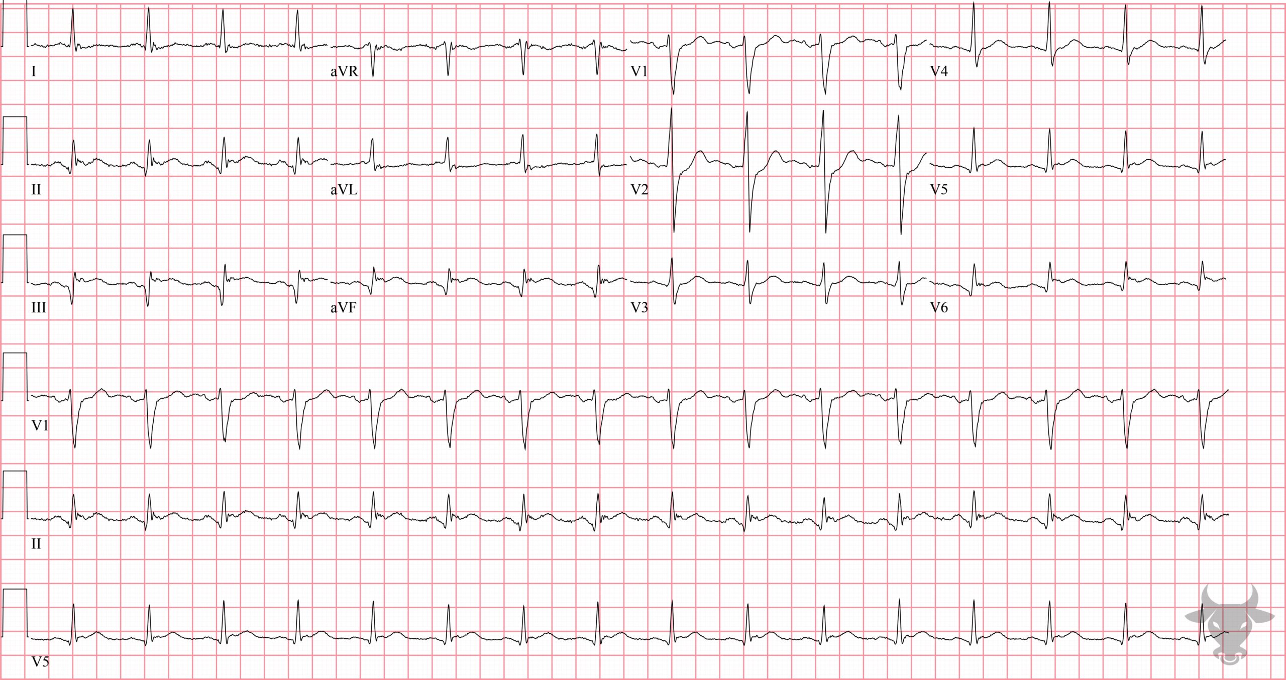 ECG Showing ST-elevation Myocardial Infarction