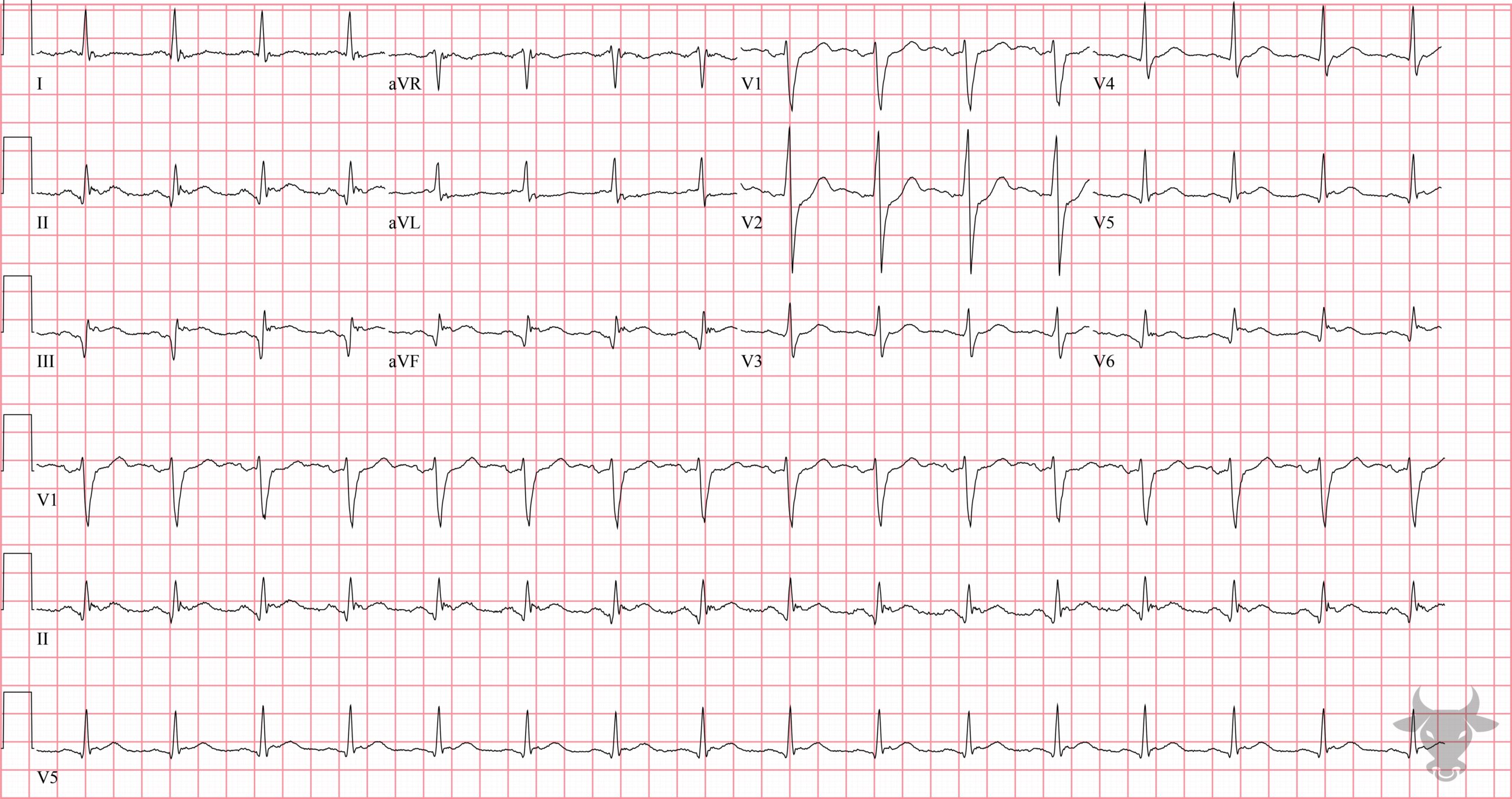 ECG Showing ST-elevation Myocardial Infarction