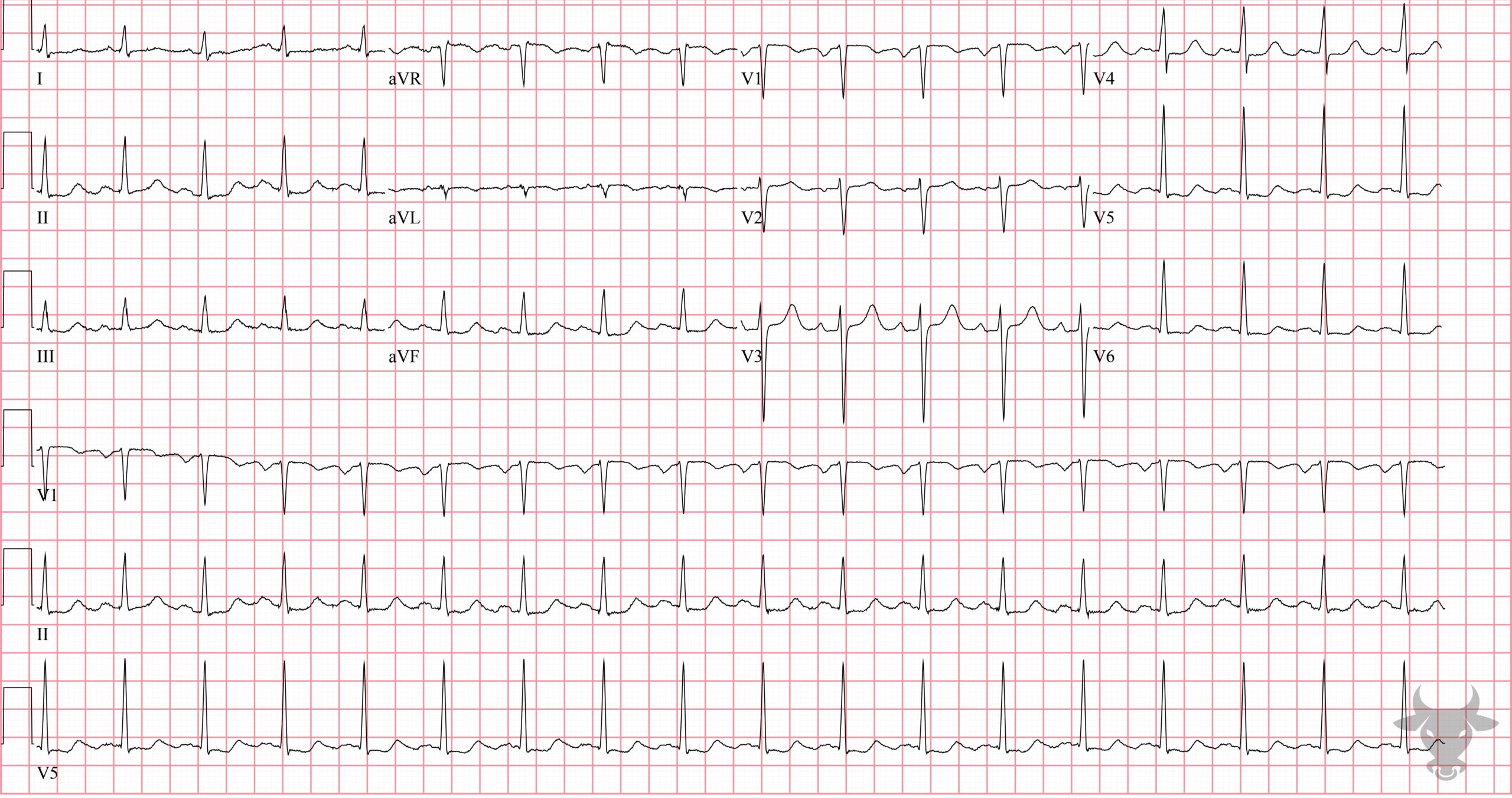 ECG Showing Global Subendocardial Ischemia