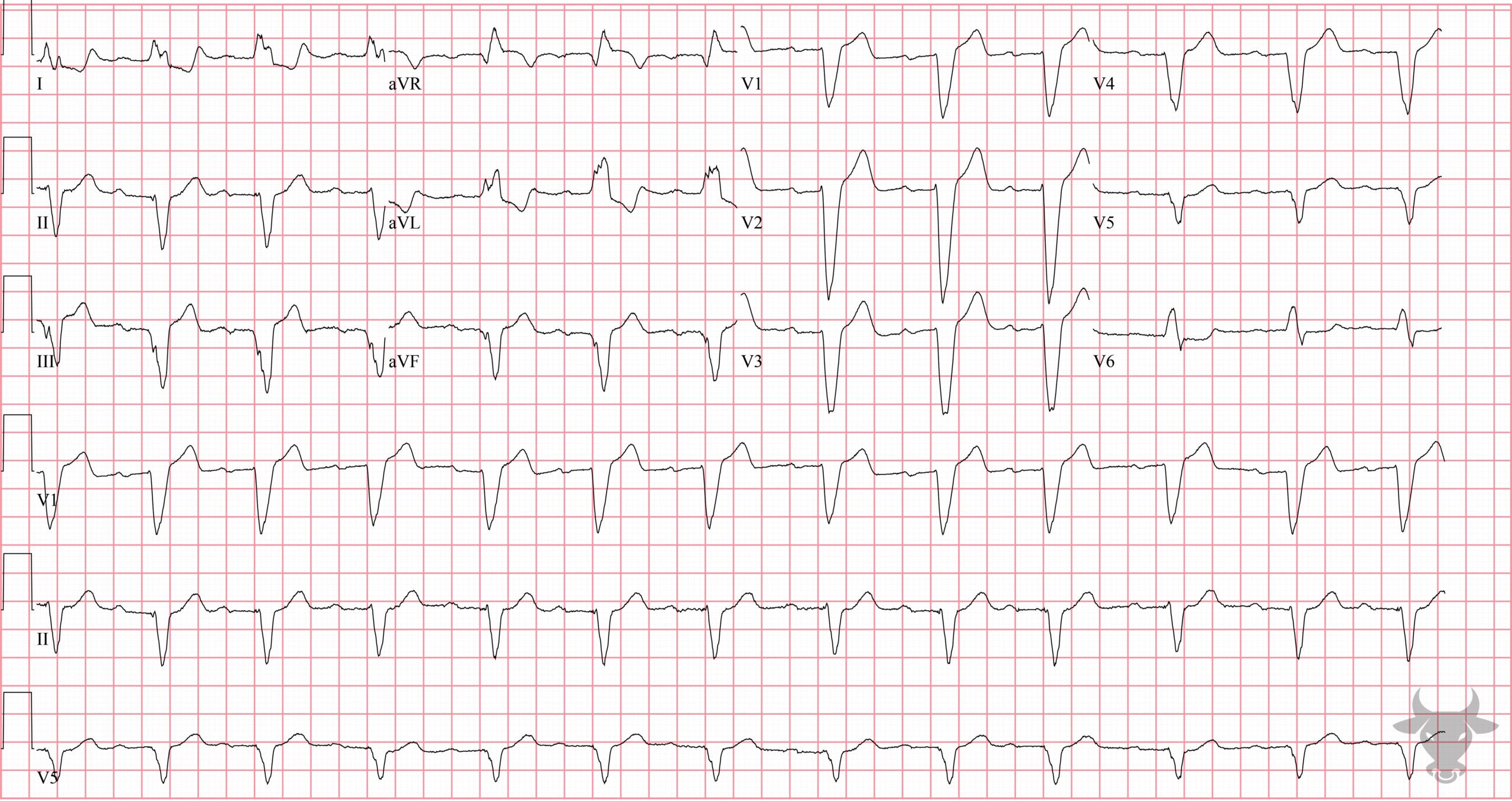 ECG Showing Left Bundle Branch Block