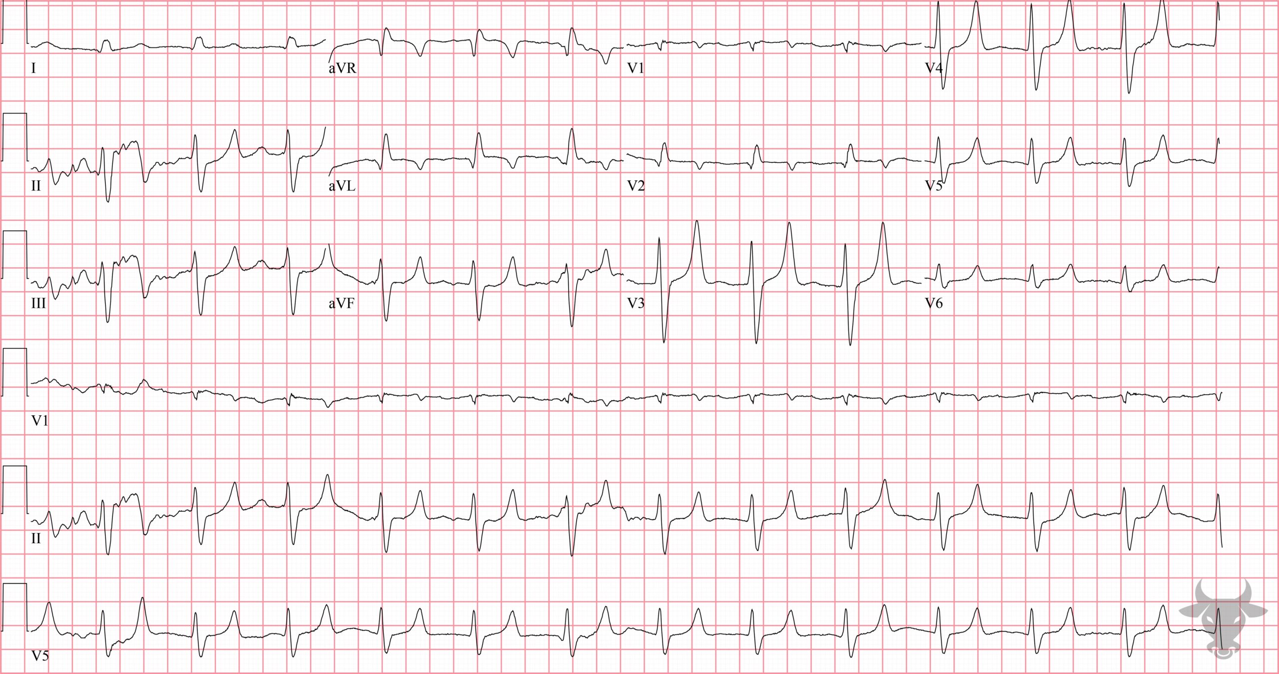 ECG Showing Hyperkalemia