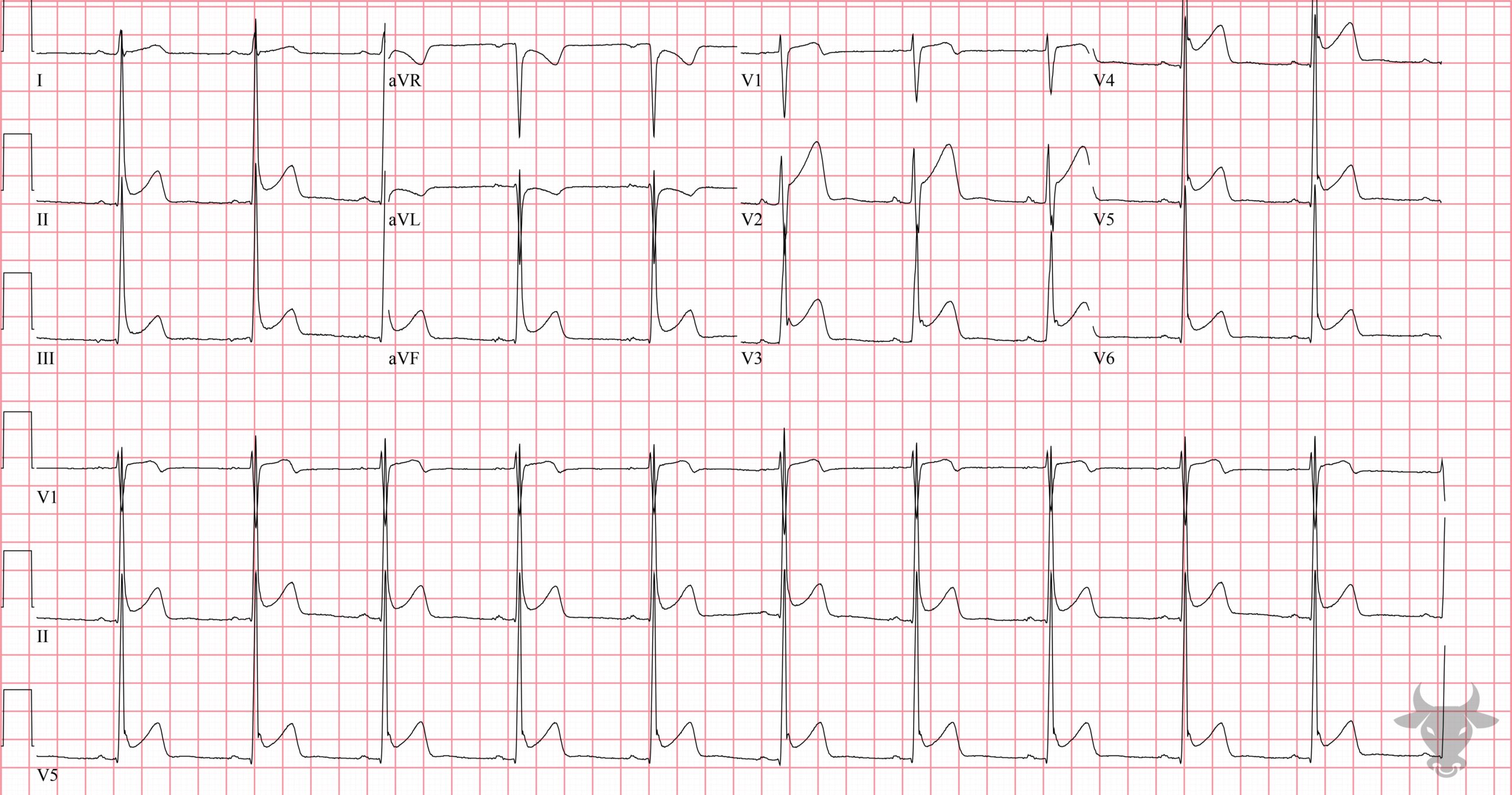 ECG Showing Early Repolarization