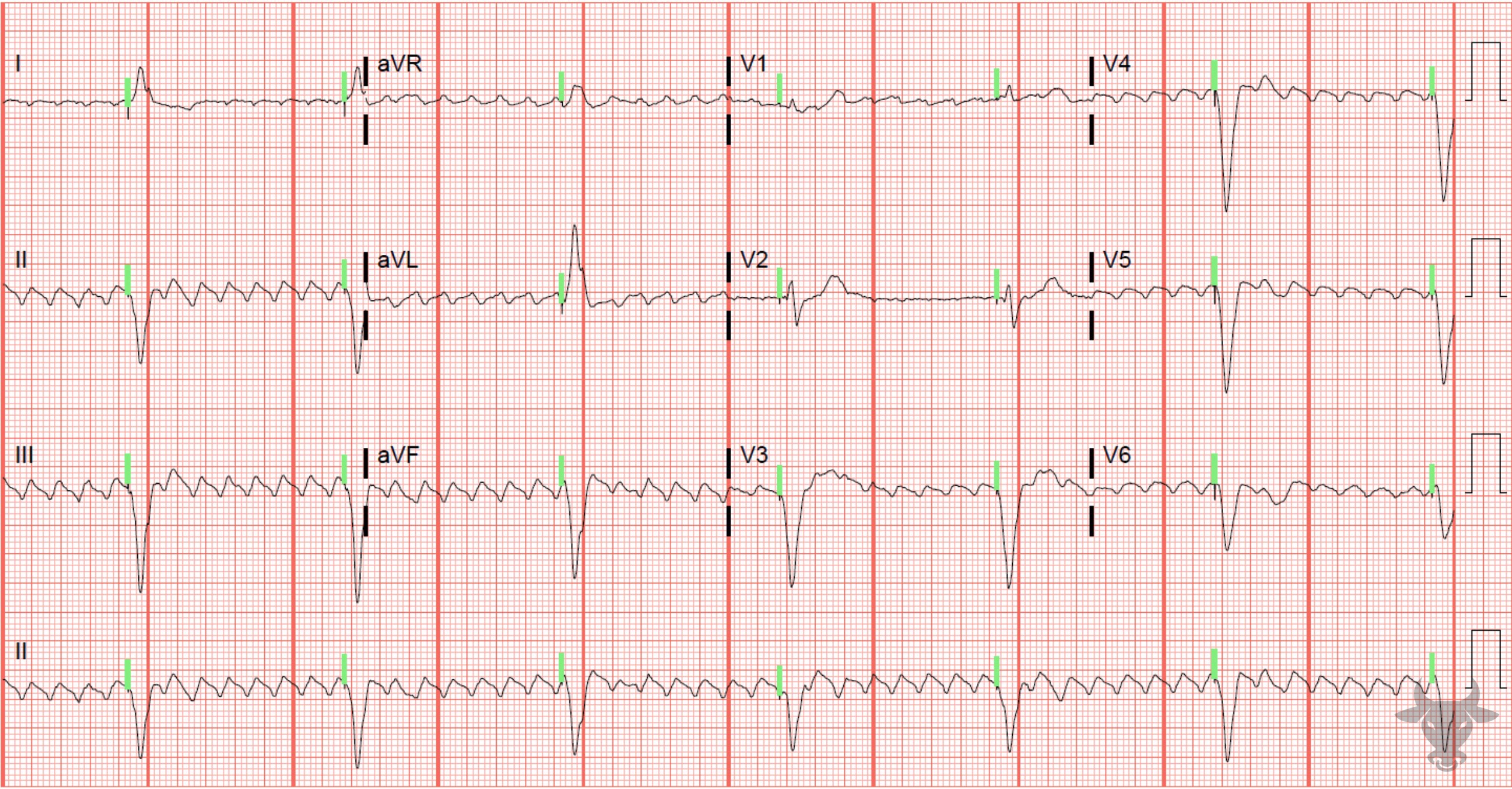 ECG Showing Paced Rhythm