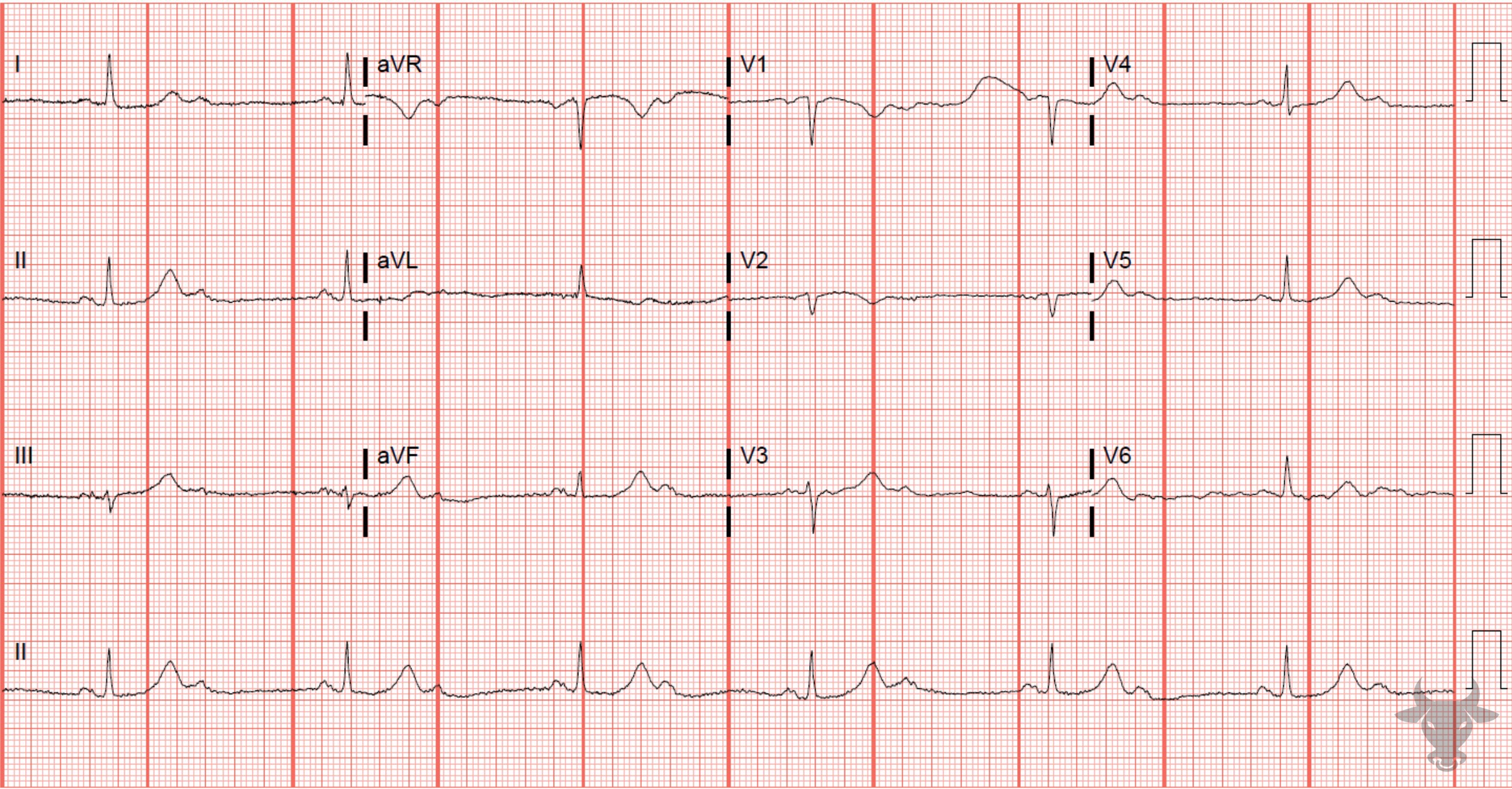 ECG Showing Second Degree Atrioventricular Block 2:1