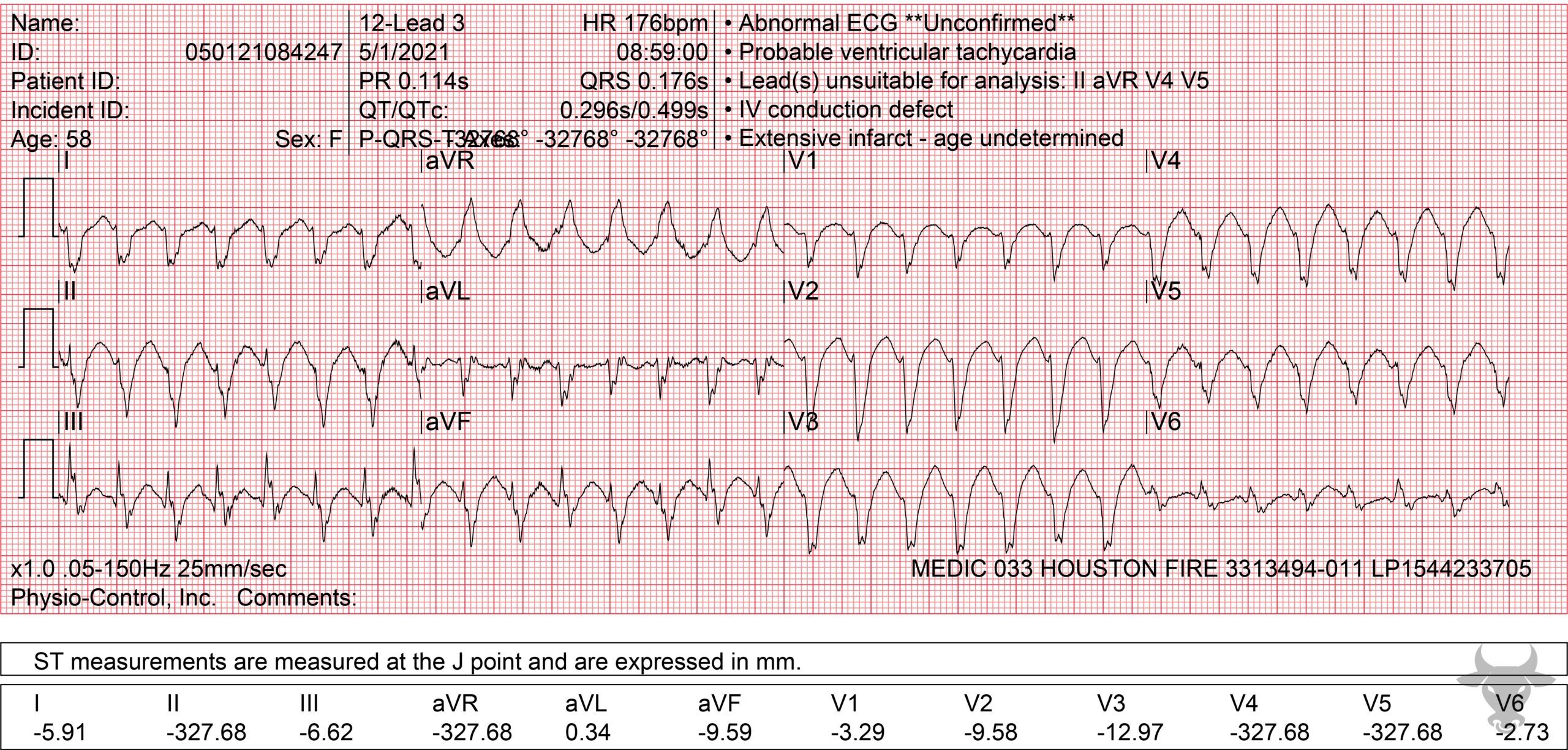 ECG Showing Ventricular Tachycardia