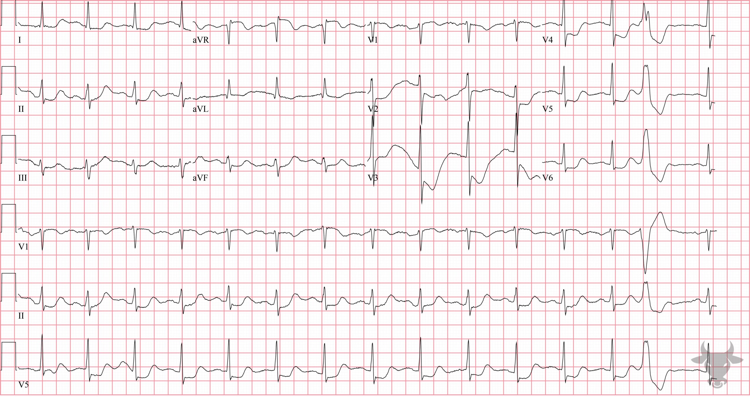 ECG Showing Global Subendocardial Ischemia