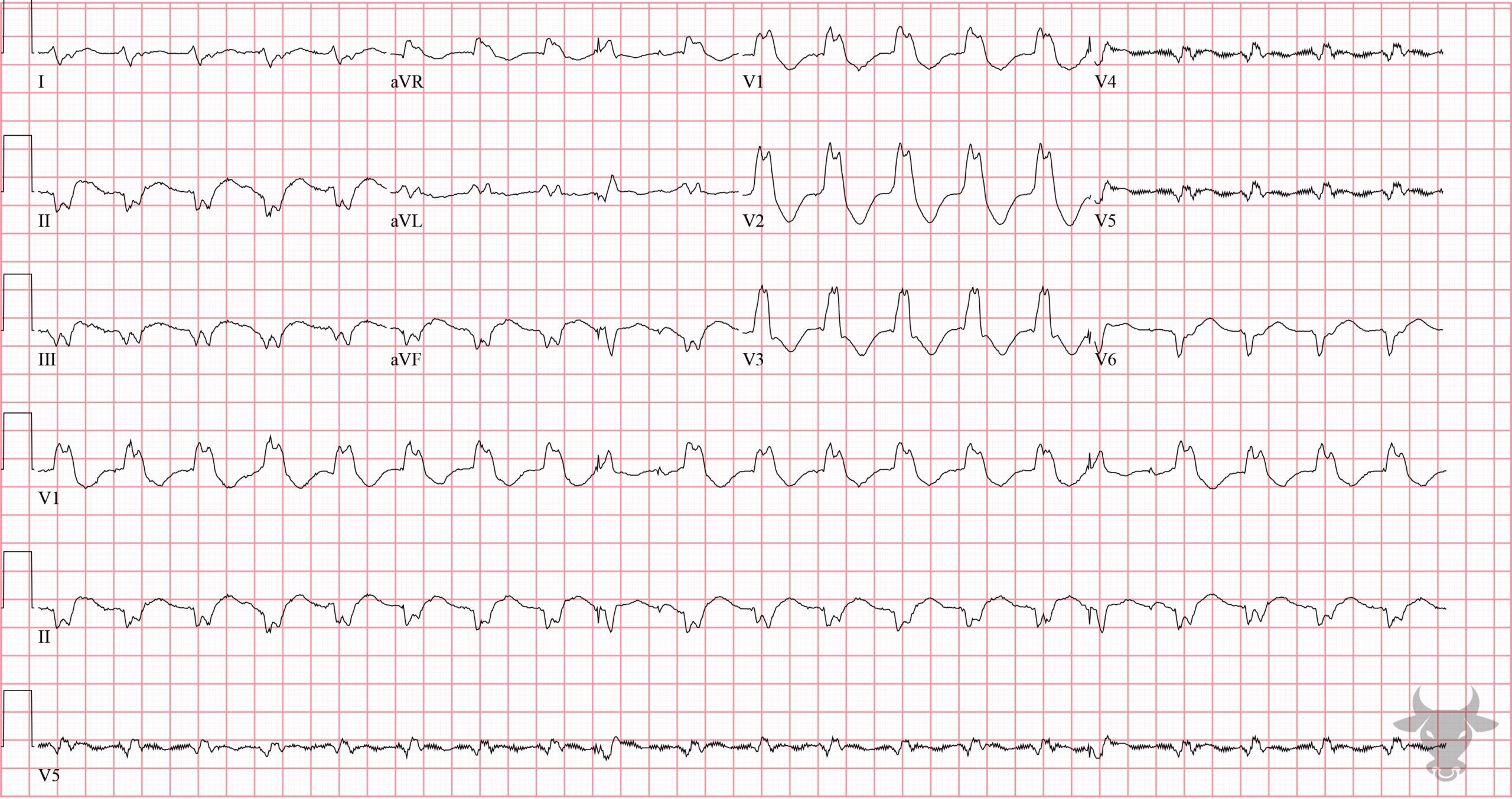 ECG Showing Ventricular Tachycardia
