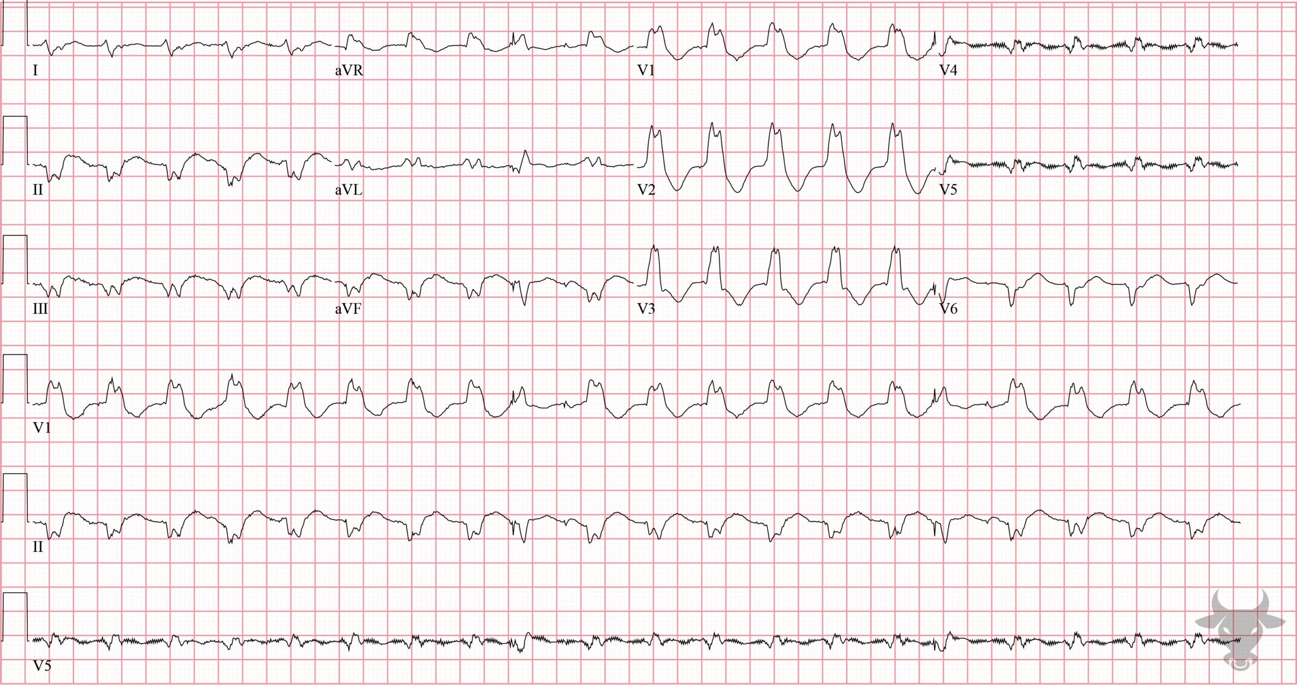 ECG Showing Ventricular Tachycardia