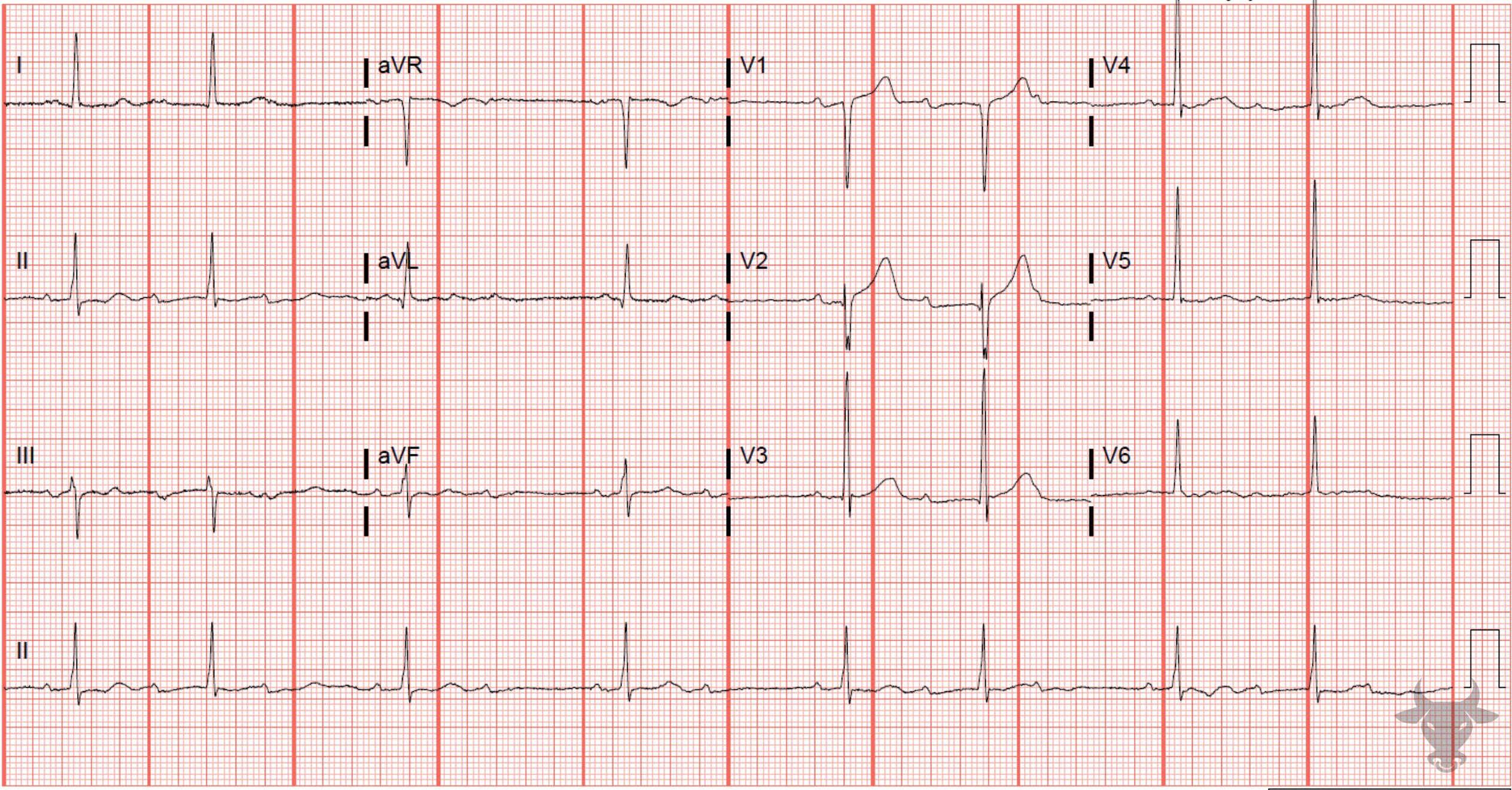 ECG Showing Second Degree Atrioventricular Block - Mobitz I