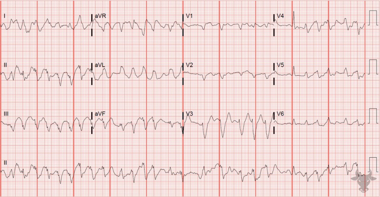 Left Bundle Branch Block | ECG Stampede