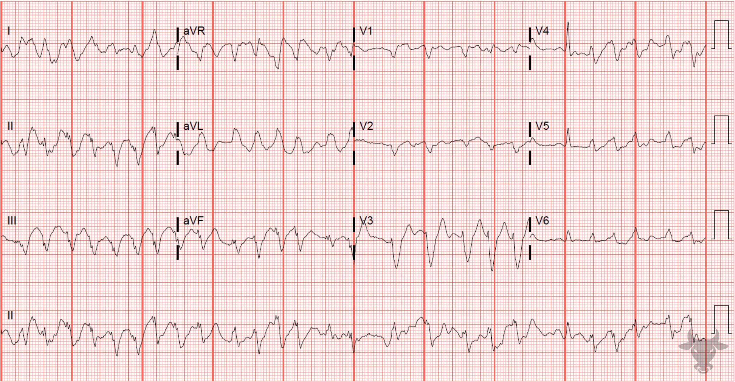 ECG Showing Left Bundle Branch Block