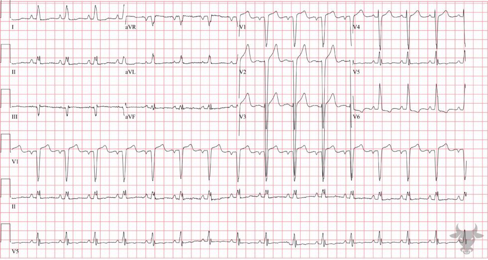T-wave Inversions | ECG Stampede