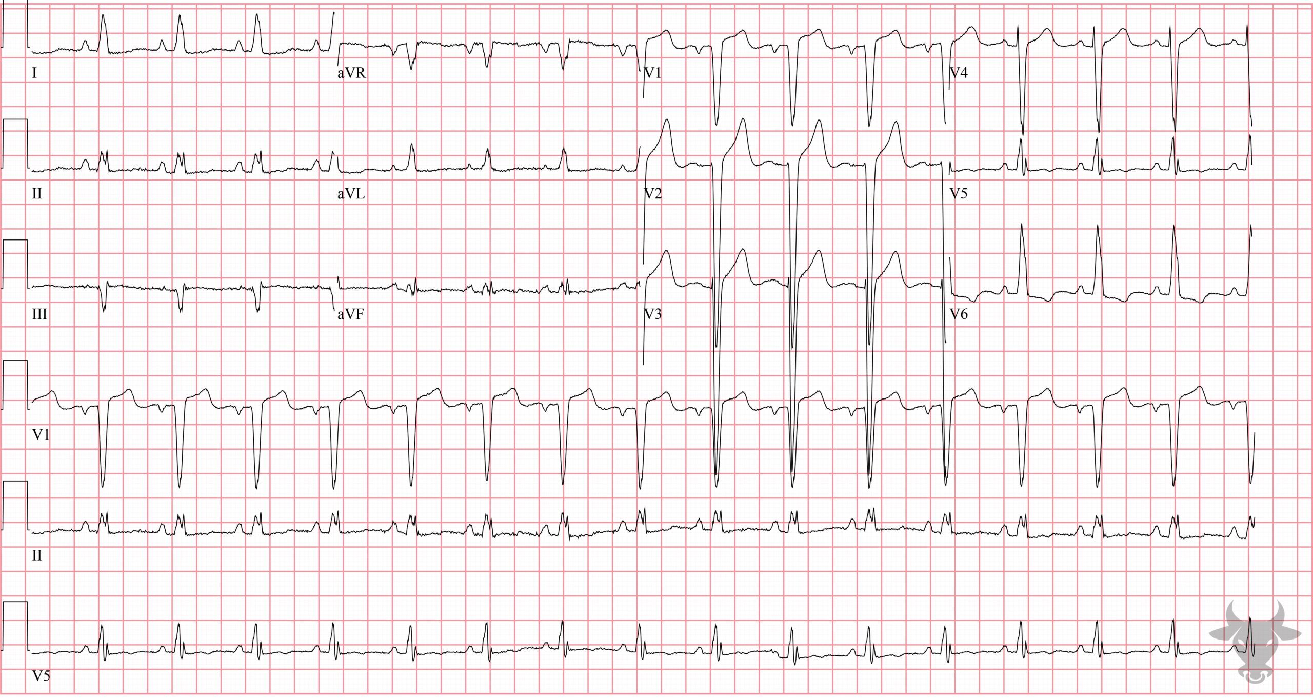 ECG Showing Left Ventricular Hypertrophy