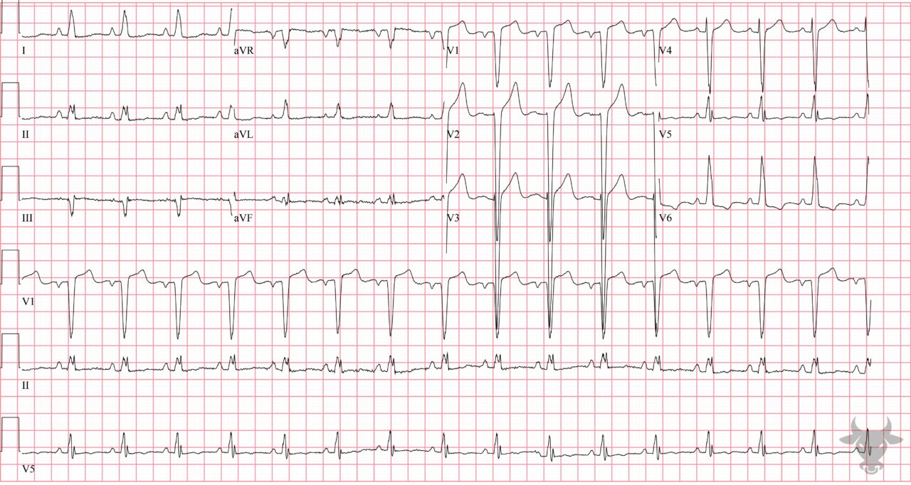 Lvh Normal Variant Left Ventricular Hypertrophy | ECG Stampede